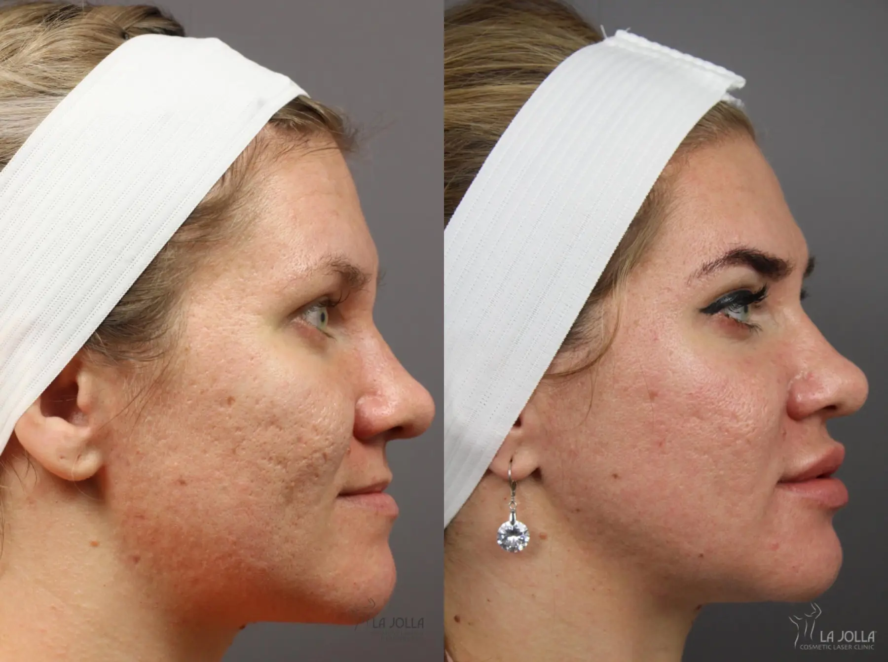 Acne: Laser Treatment: Patient 12 - Before and After 1