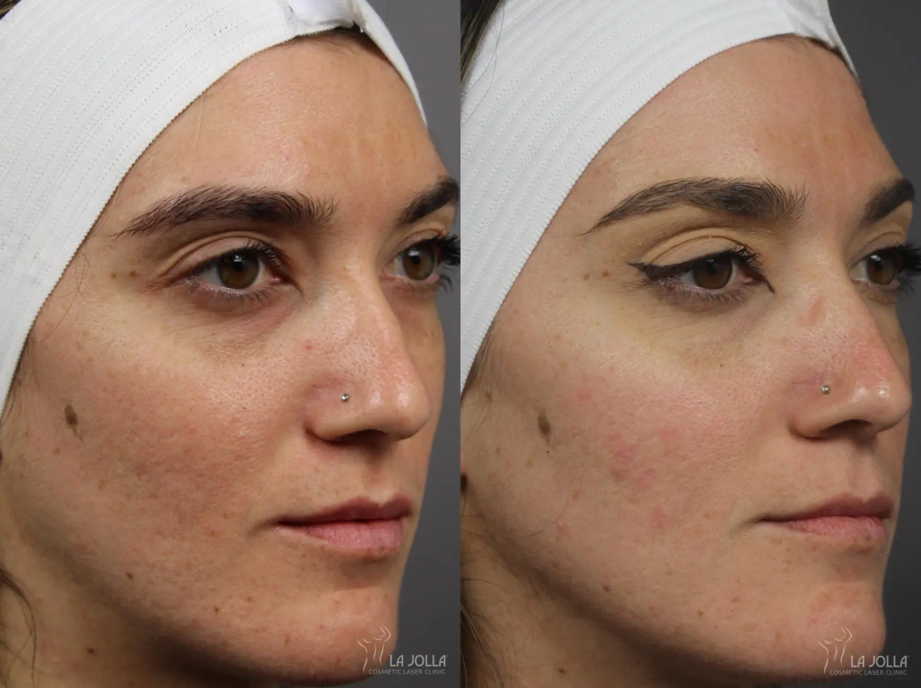 Acne: Laser Treatment: Patient 14 - Before and After 1