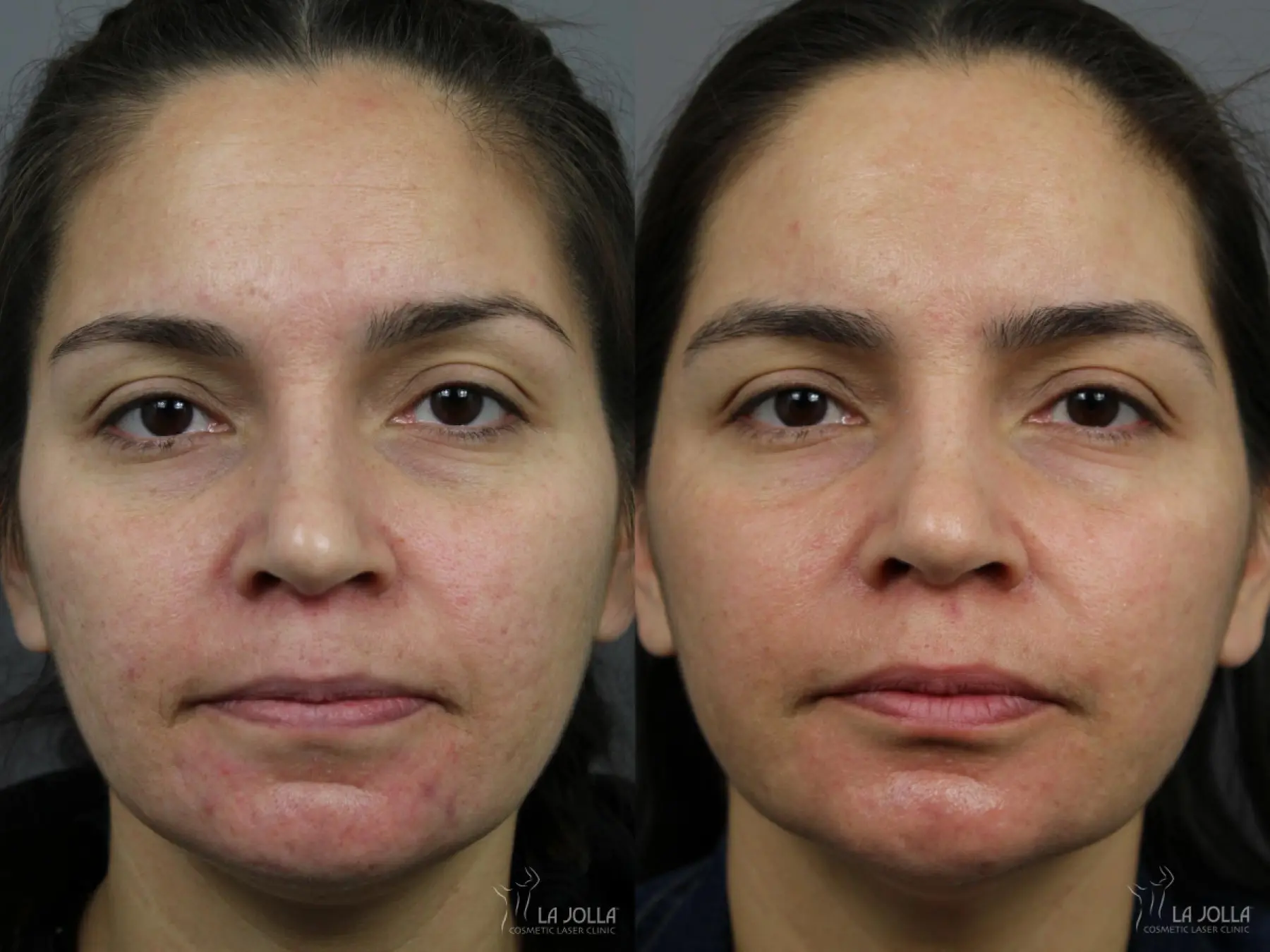 Acne: Laser Treatment: Patient 5 - Before and After 2