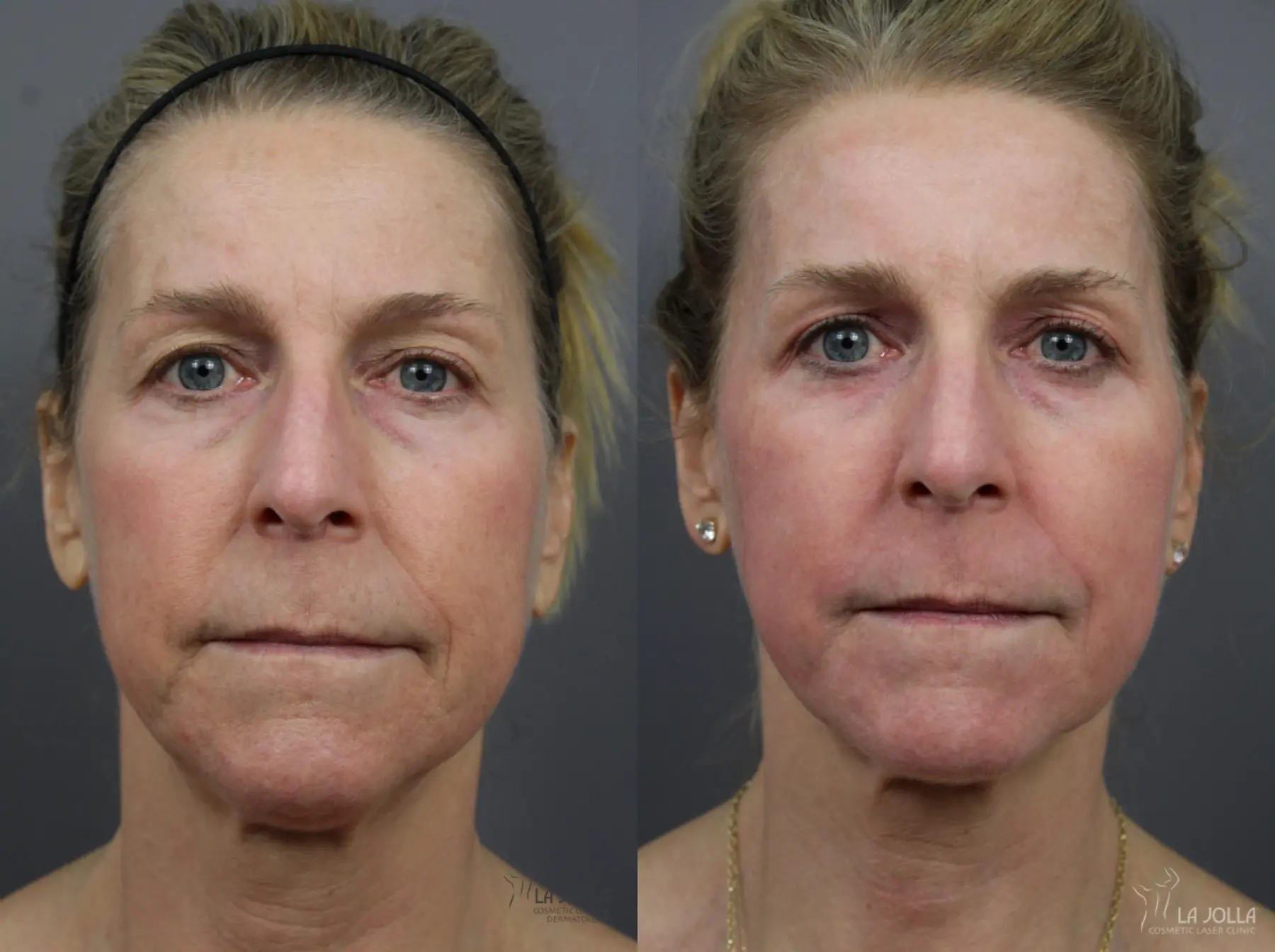 Fractional CO2: Patient 5 - Before and After