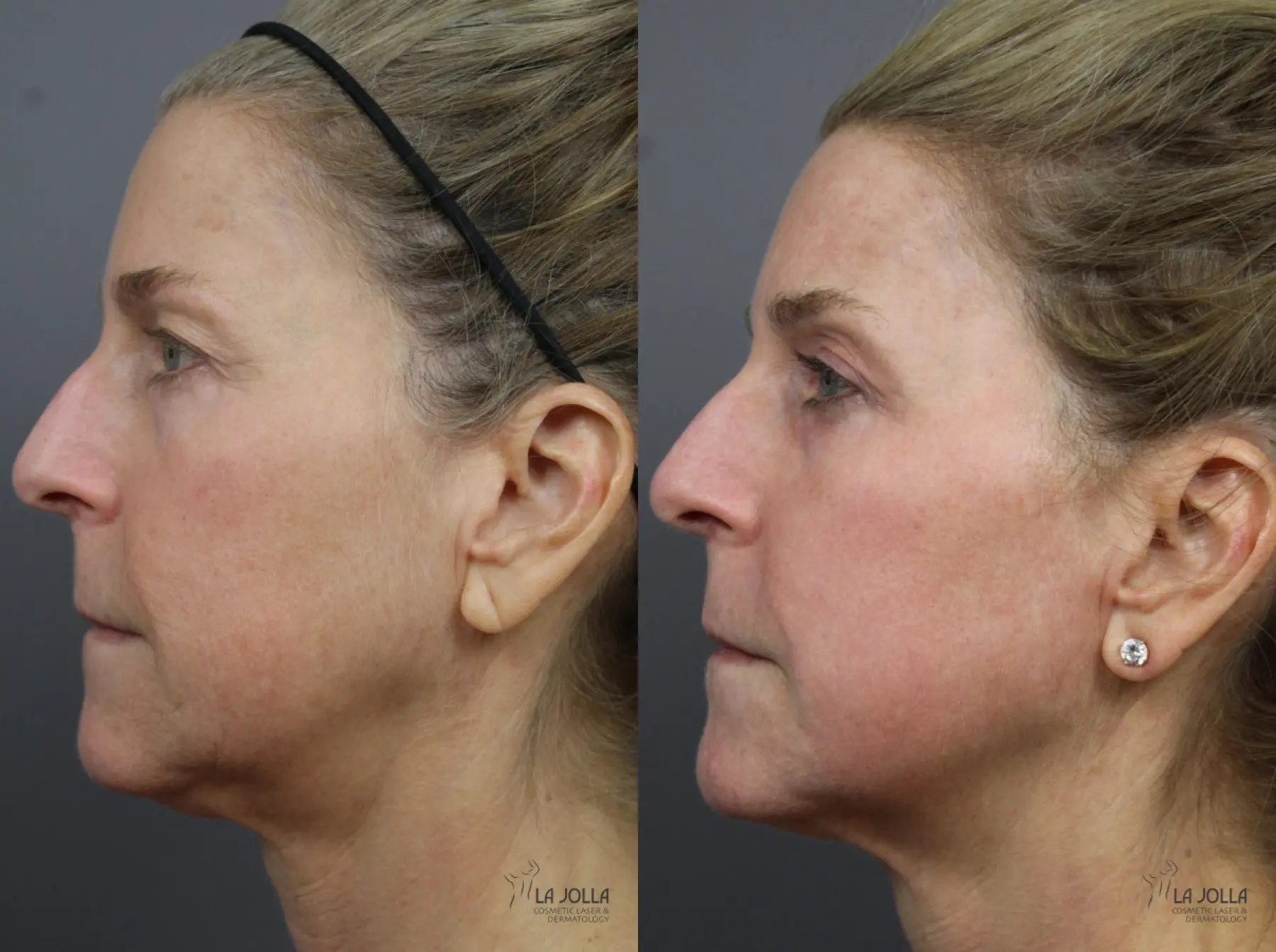 Fractional CO2: Patient 5 - Before and After 2
