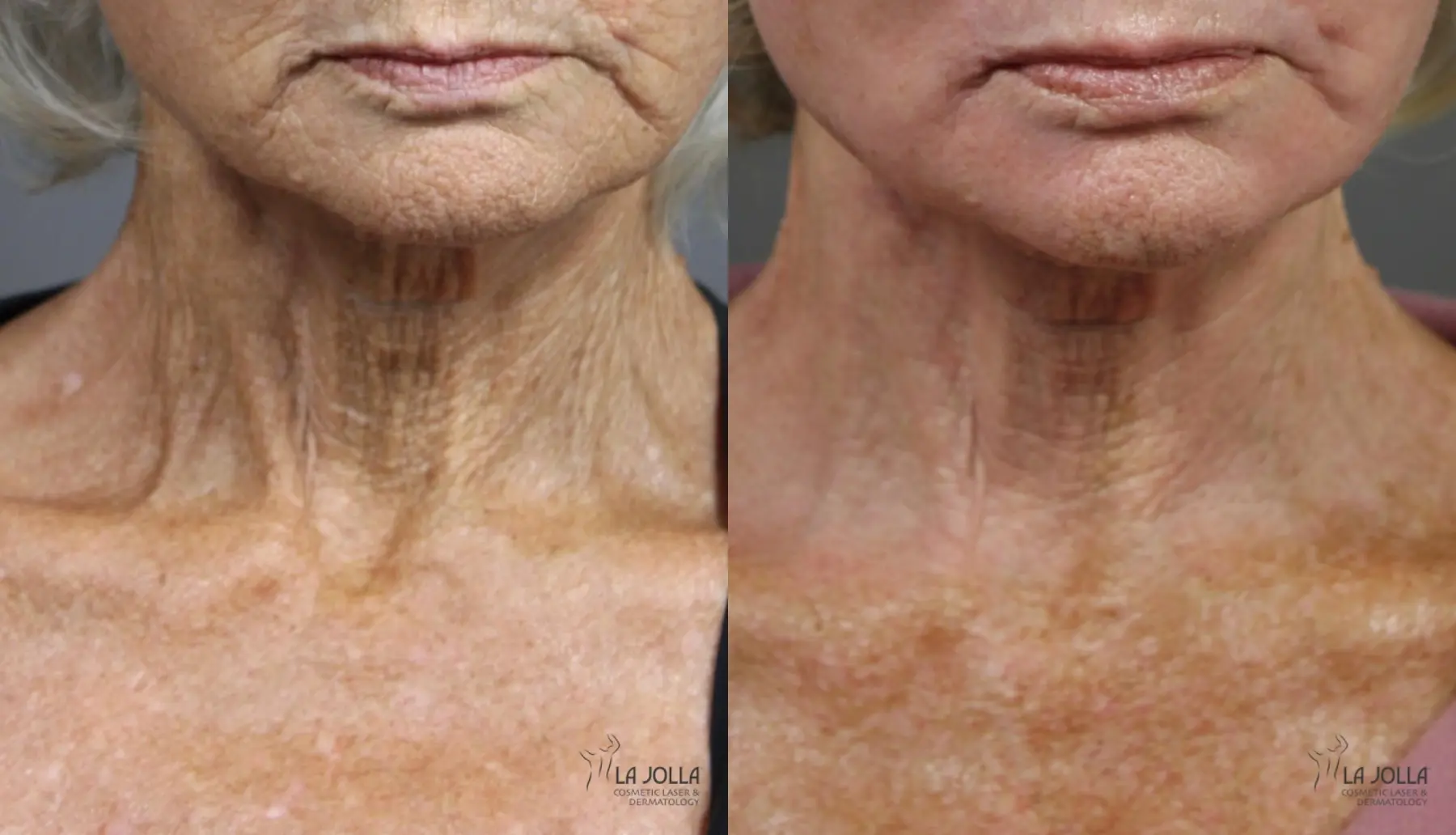 Fractional CO2: Patient 2 - Before and After 4