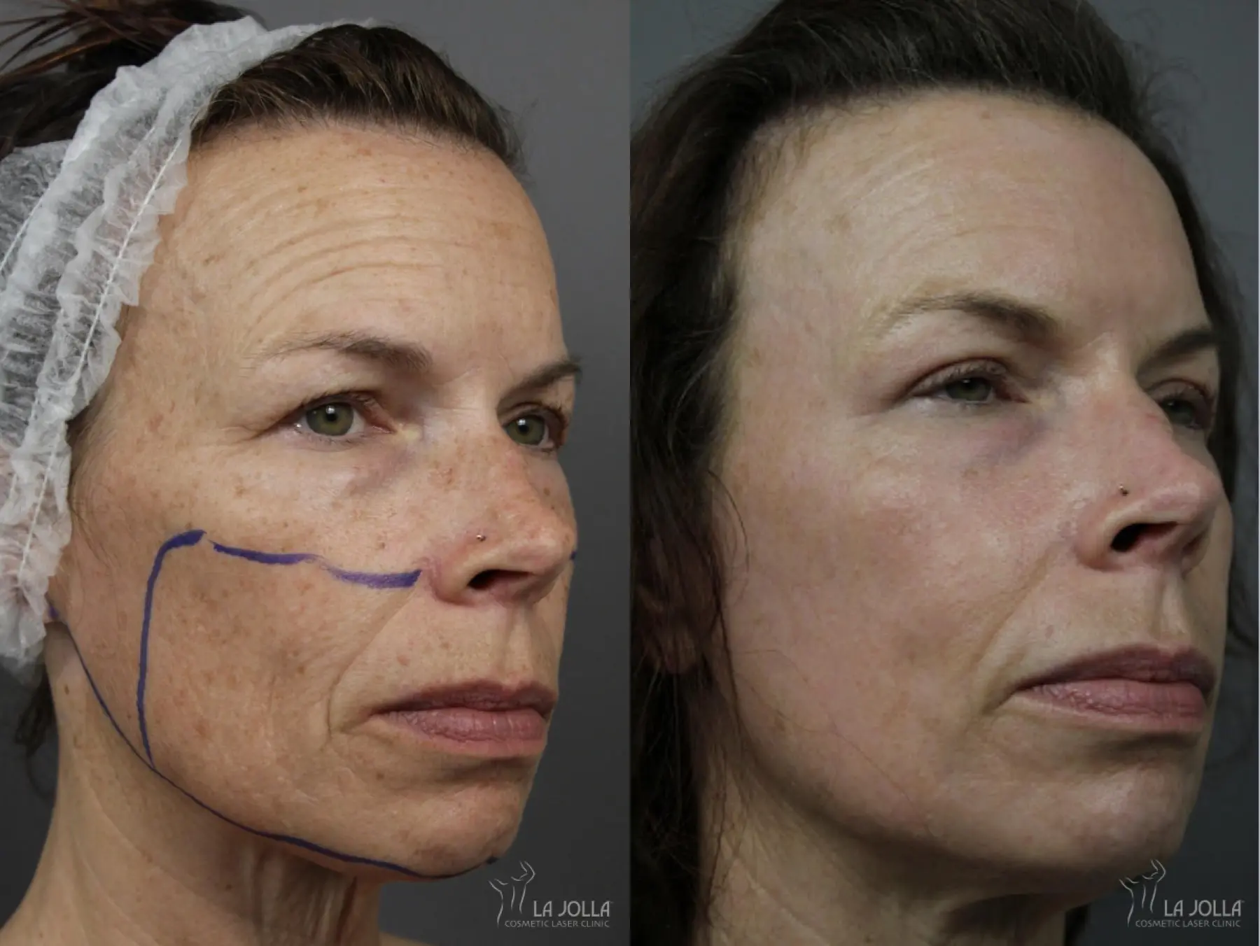 Fractional CO2: Patient 4 - Before and After
