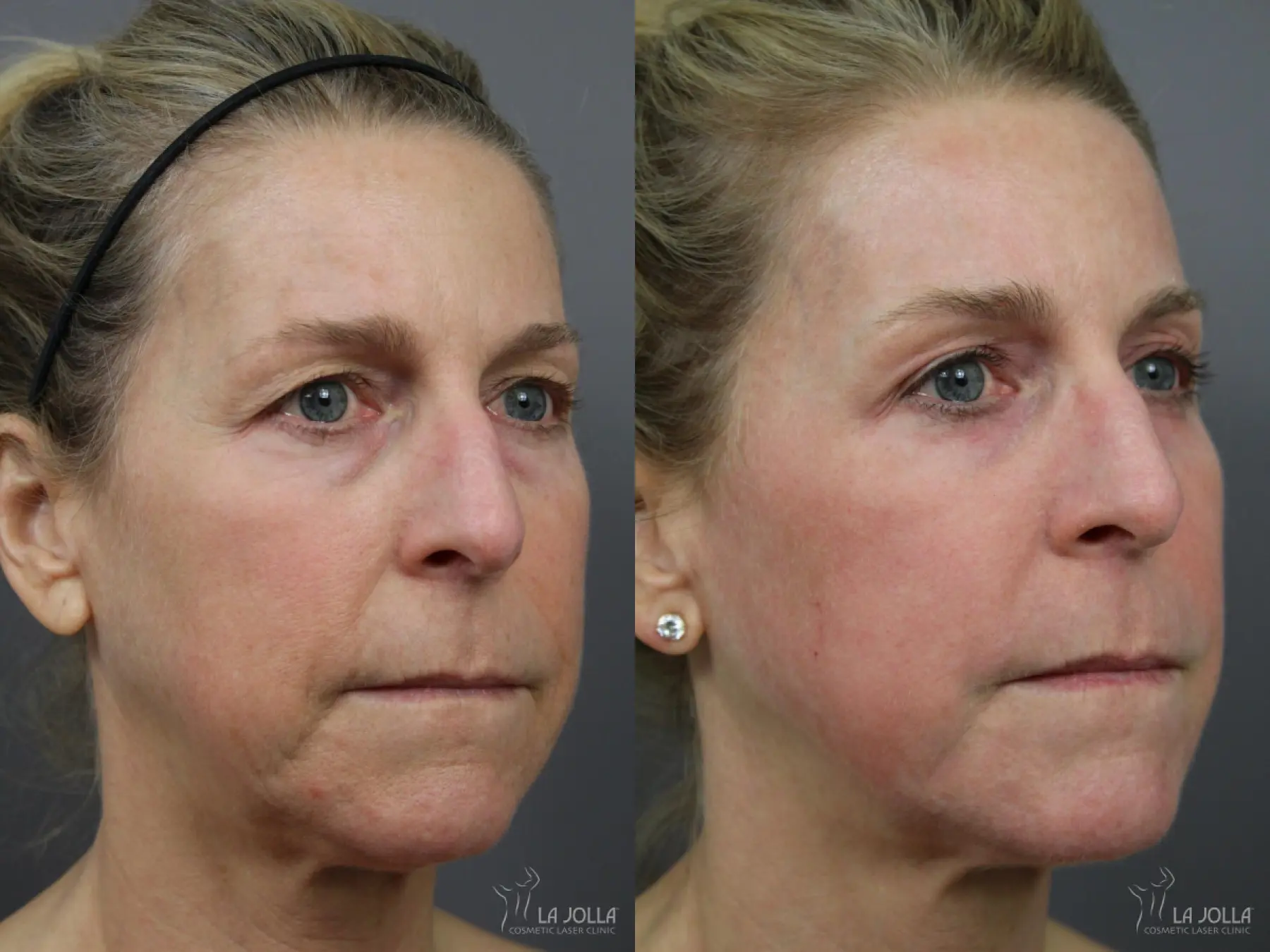 Fractional CO2: Patient 5 - Before and After 3