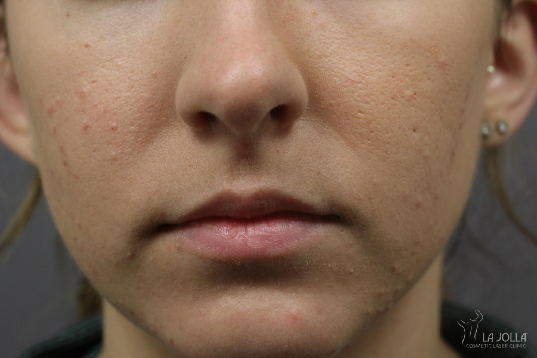 Lip Filler: Patient 13 - Before 1