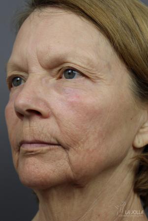 SP Dynamis: Patient 4 - After  