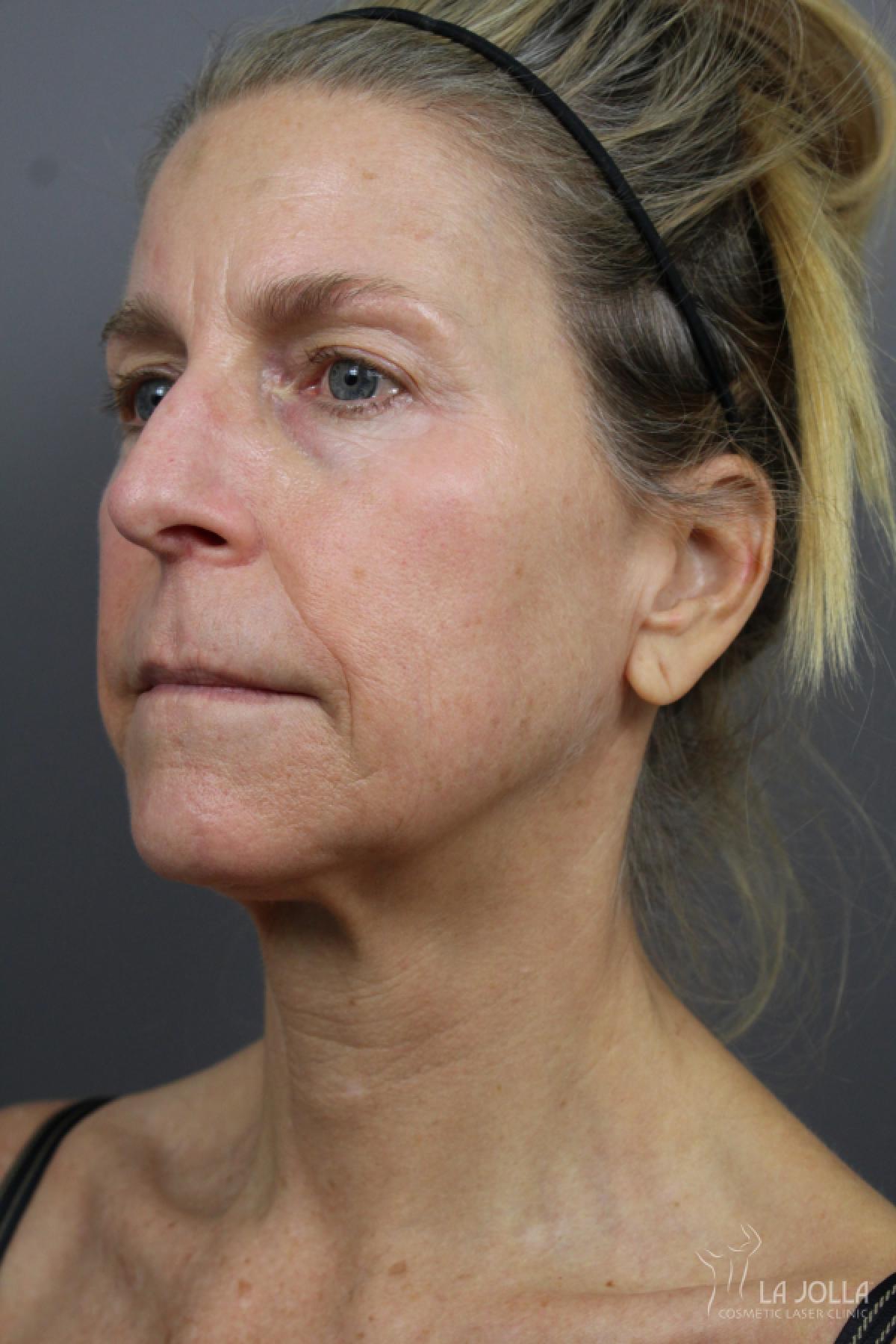 6D Platinum Laser Lift: Patient 3 - Before and After 3