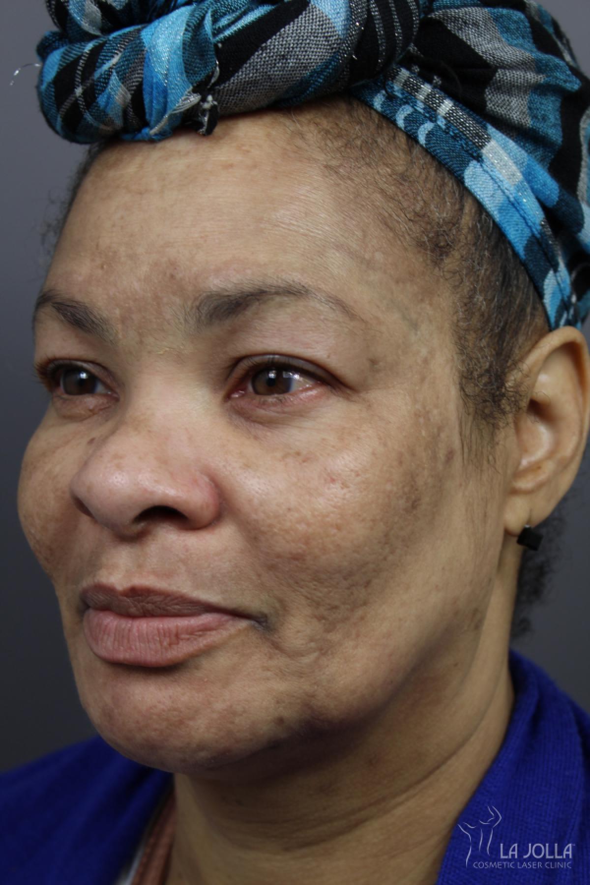 Chemical Peel: Patient 4 - Before 1