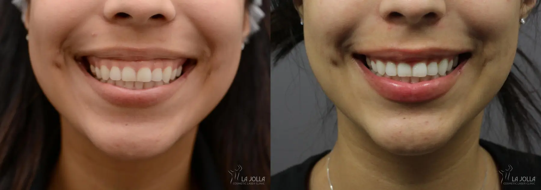 BOTOX®: Patient 2 - Before and After  
