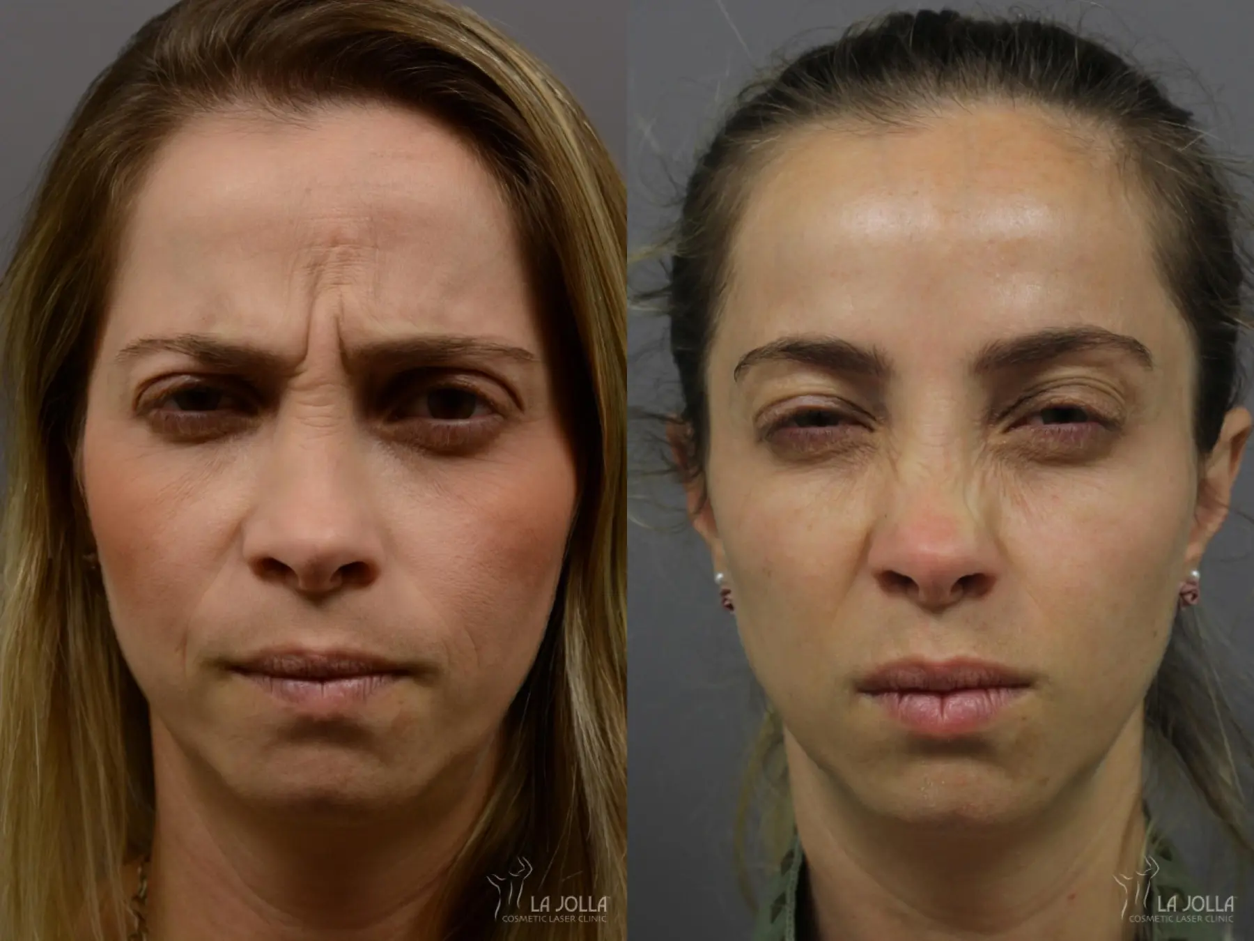 BOTOX®: Patient 1 - Before and After 3