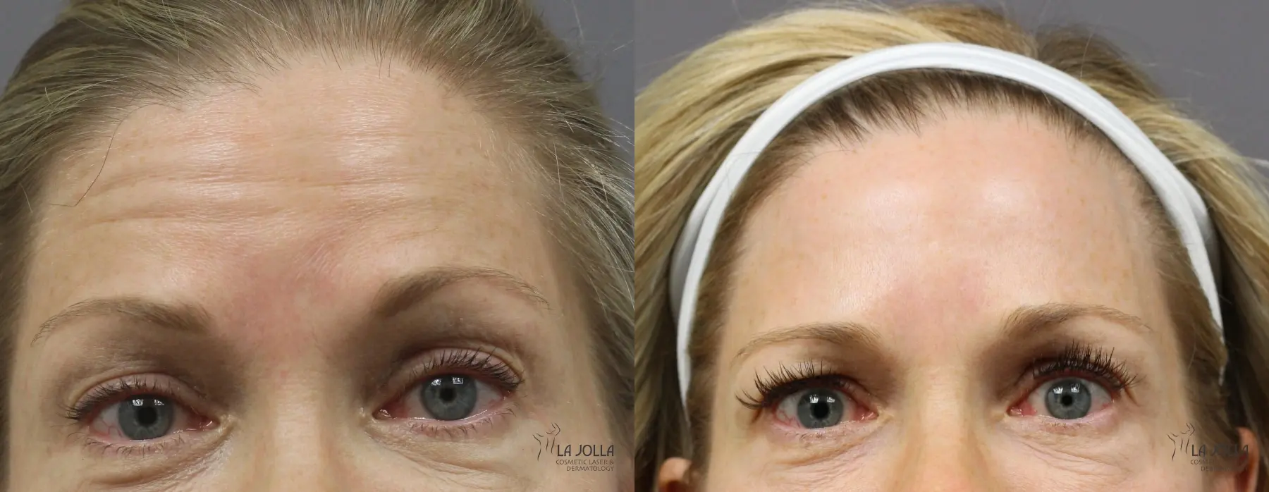 BOTOX®: Patient 3 - Before and After  