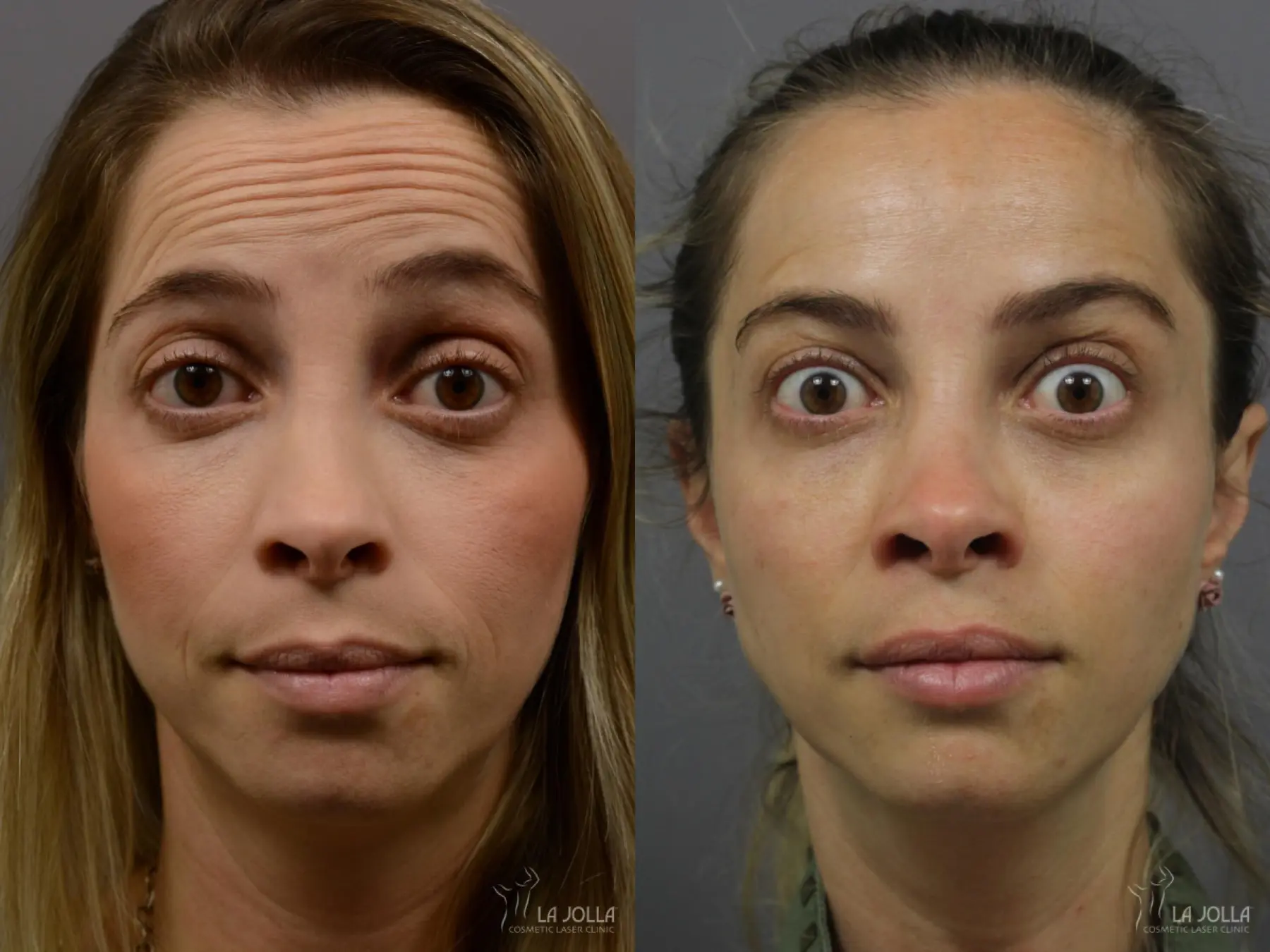 BOTOX®: Patient 1 - Before and After  