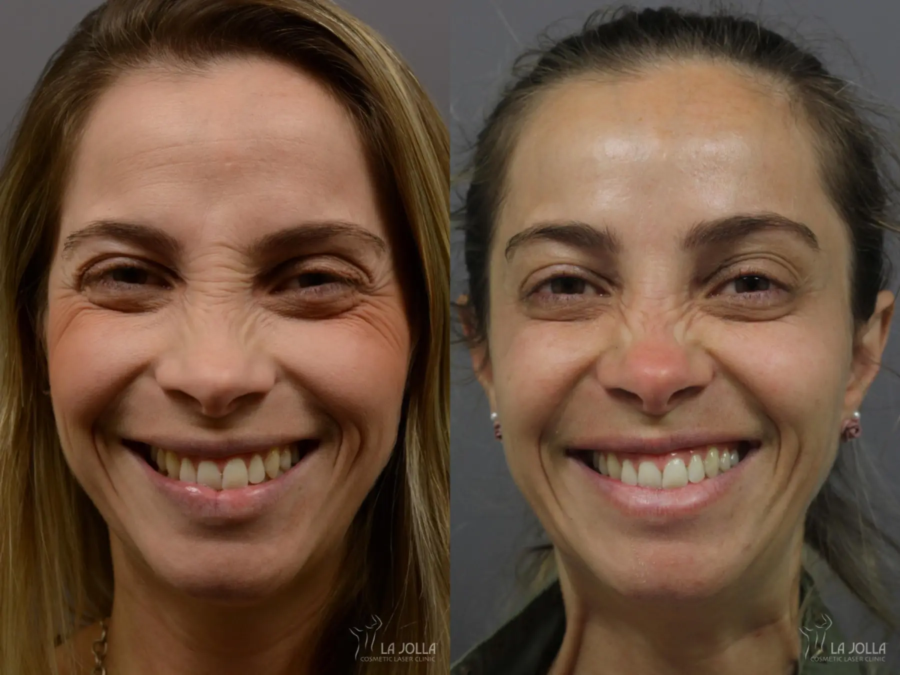BOTOX®: Patient 1 - Before and After 2