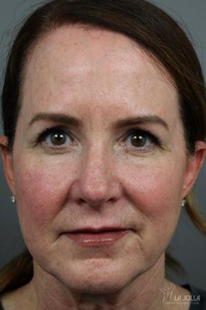 Sculptra®: Patient 2 - After  