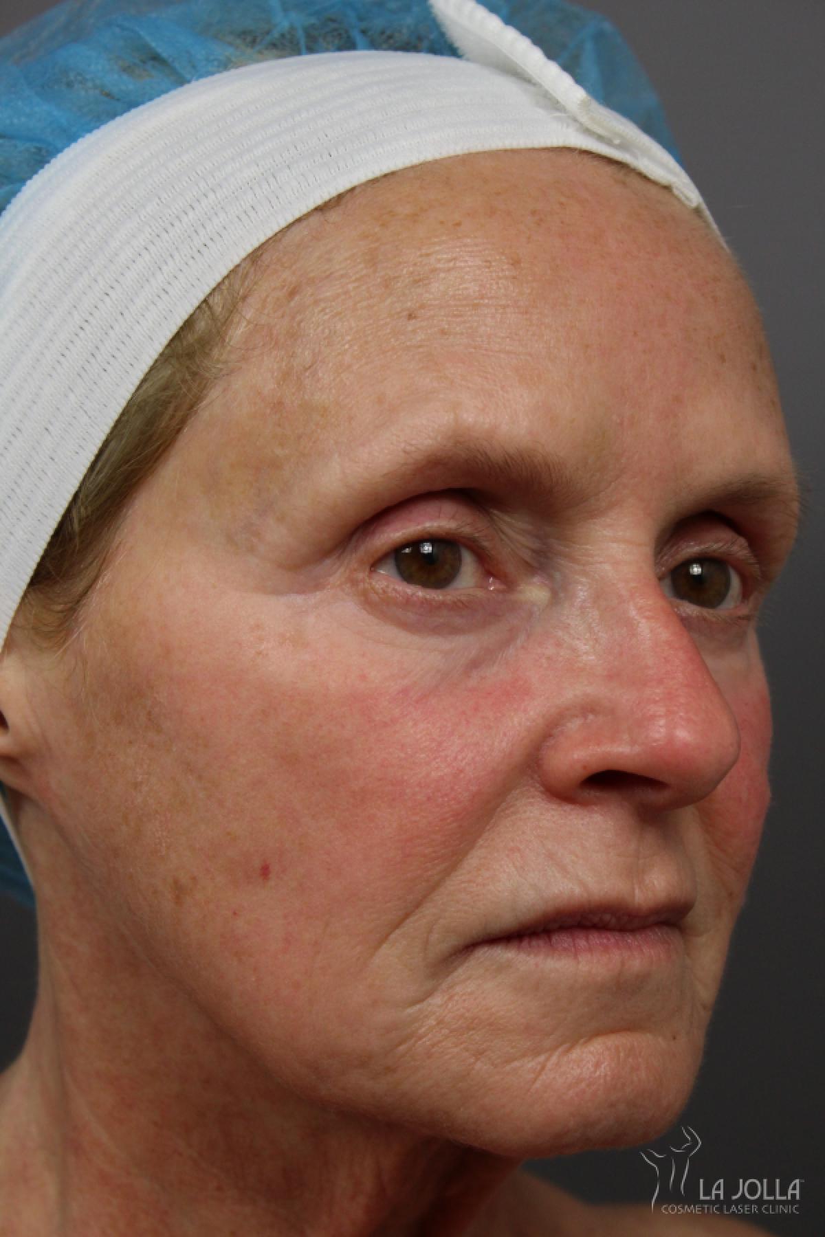 Laser Skin Resurfacing: Patient 2 - Before and After 2