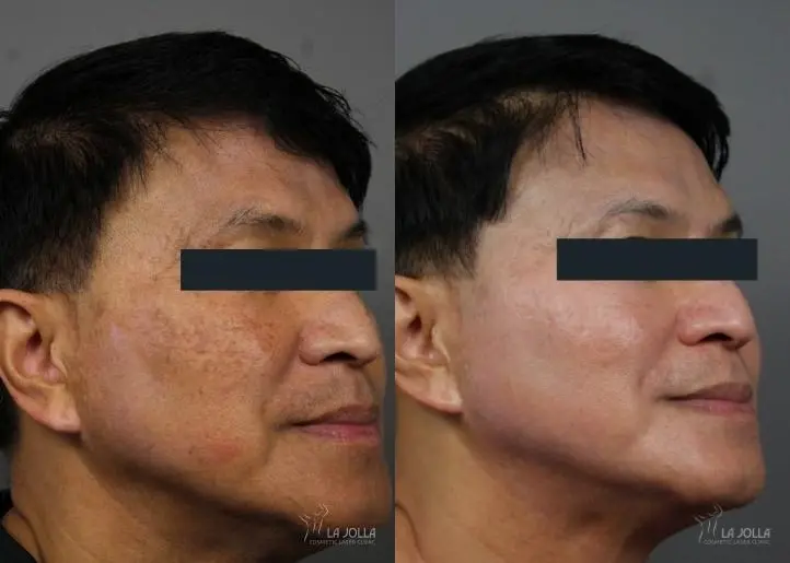 Chemical Peel: Patient 1 - Before and After 2