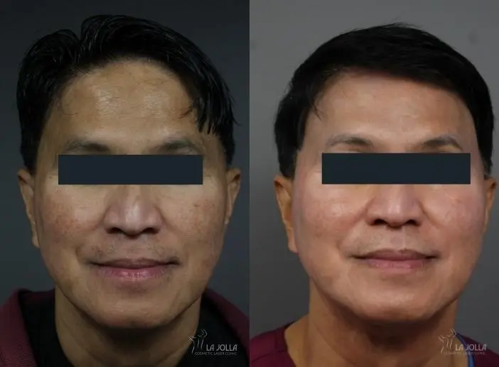 Chemical Peel: Patient 1 - Before and After  