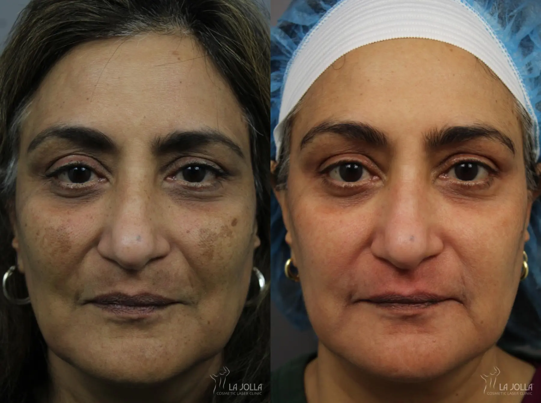 Chemical Peel: Patient 12 - Before and After 1