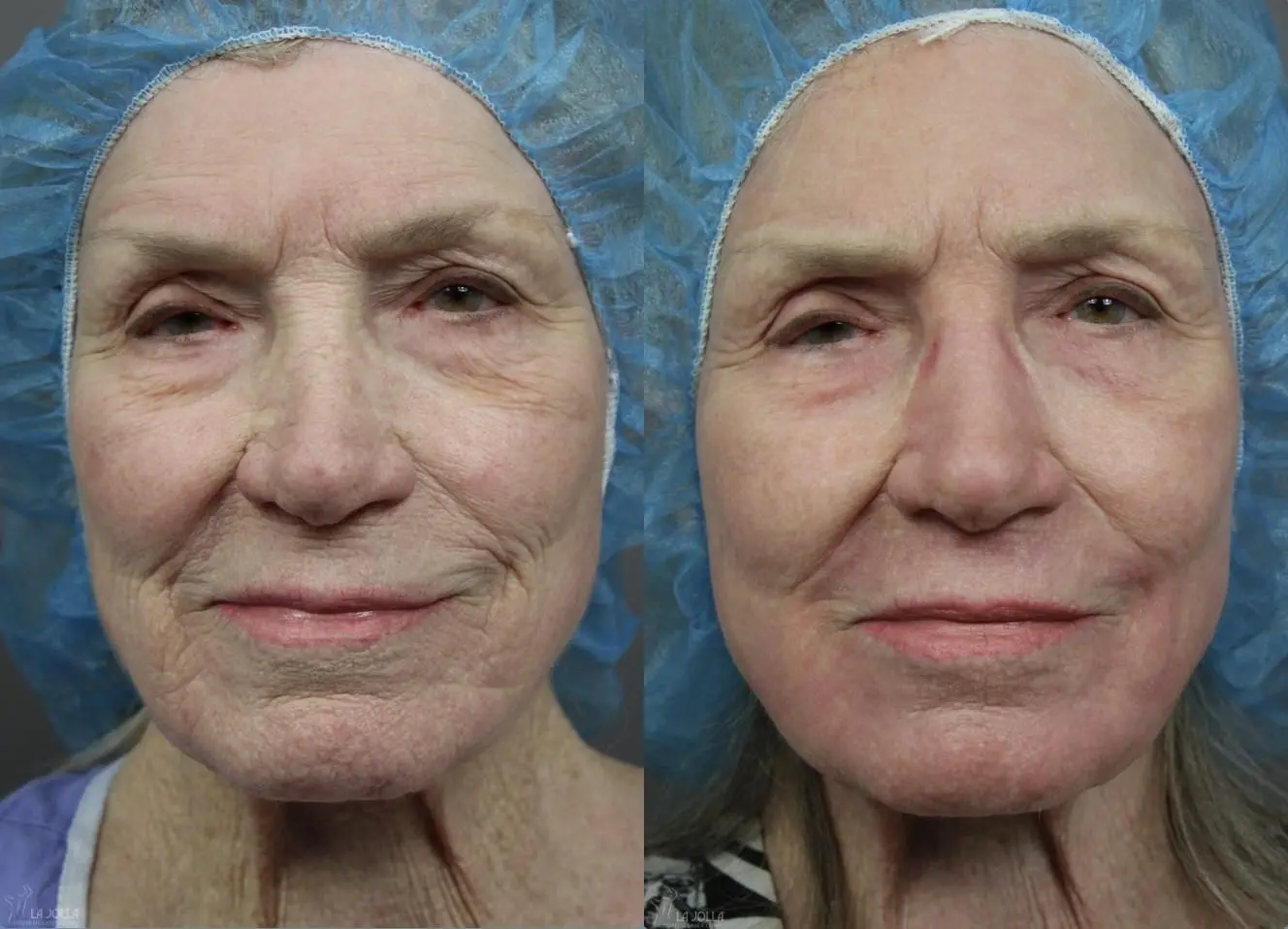 CO2 Laser: Patient 1 - Before and After  