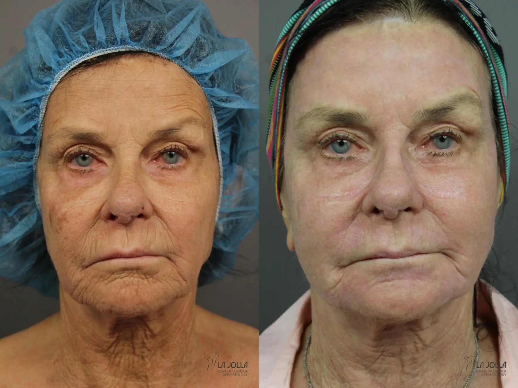 CO2 Laser: Patient 1 - Before and After 1