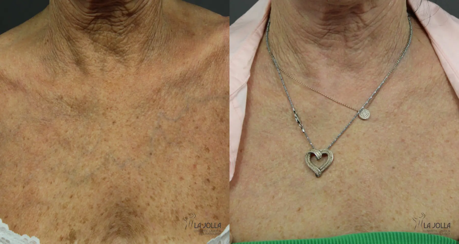 CO2 Laser: Patient 1 - Before and After 4