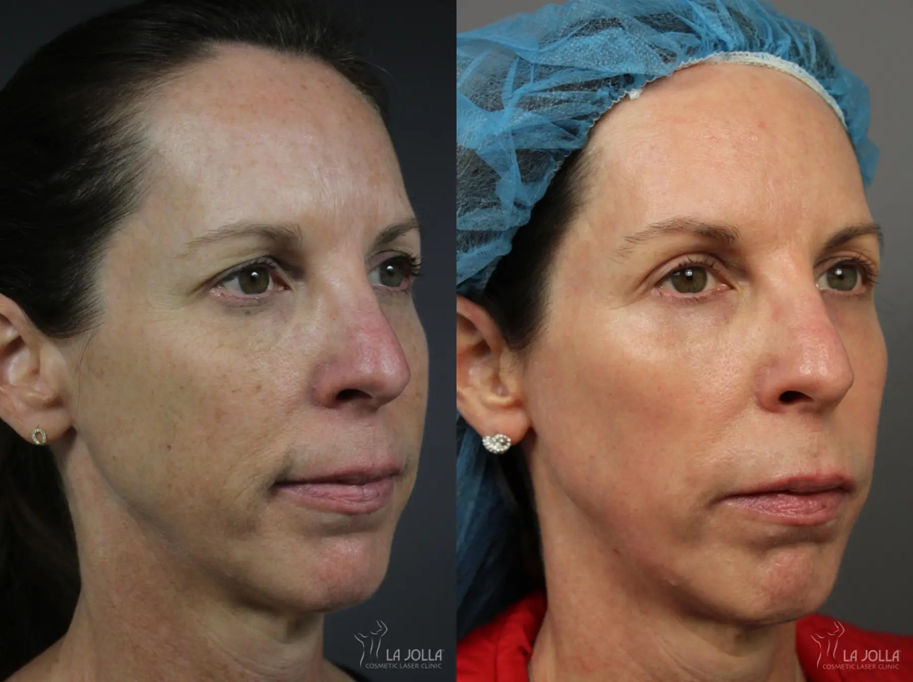 CO2 Laser: Patient 7 - Before and After 2