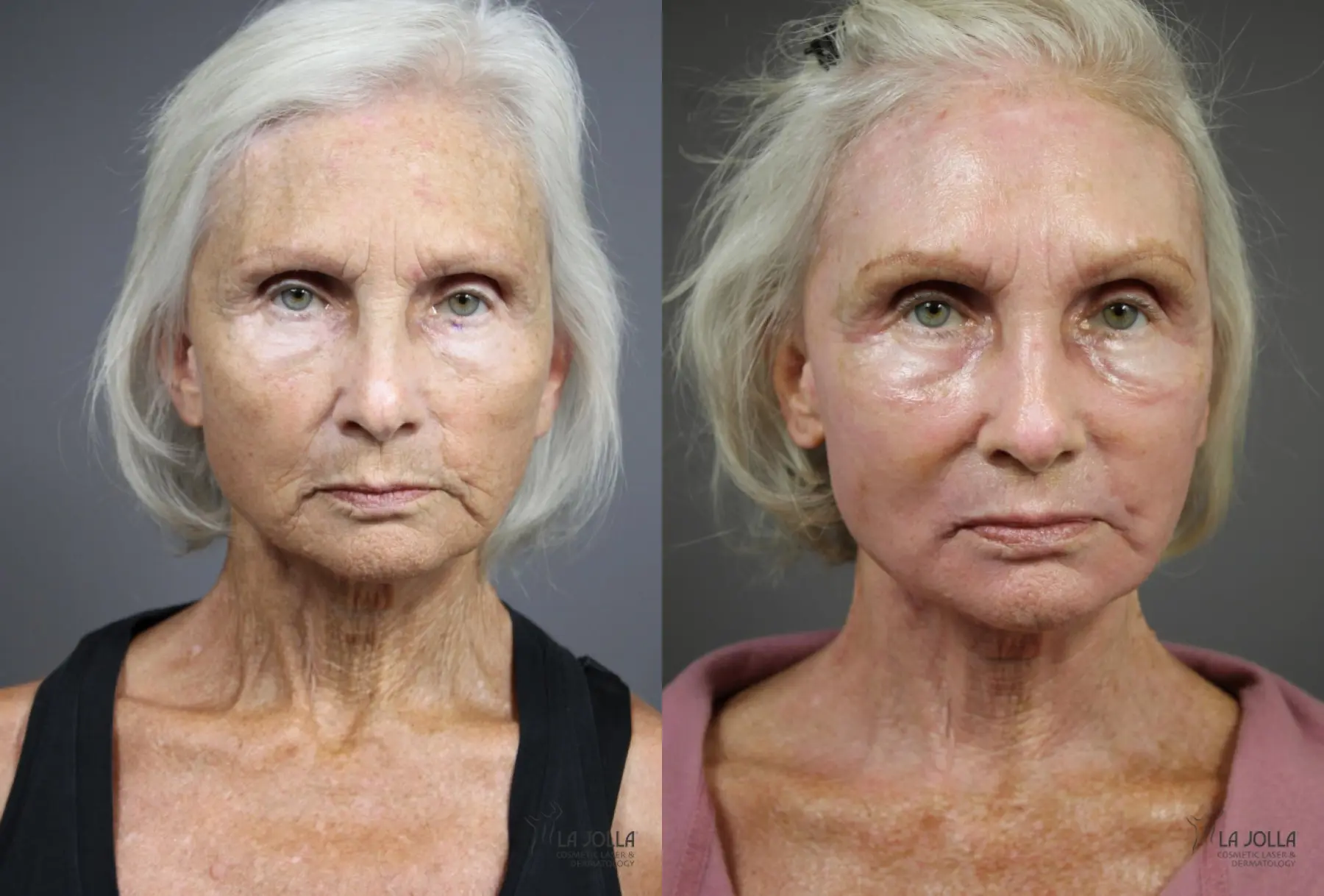 CO2 Laser: Patient 2 - Before and After 1