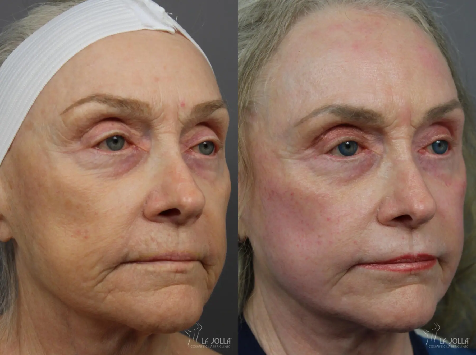 CO2 Laser: Patient 13 - Before and After 1