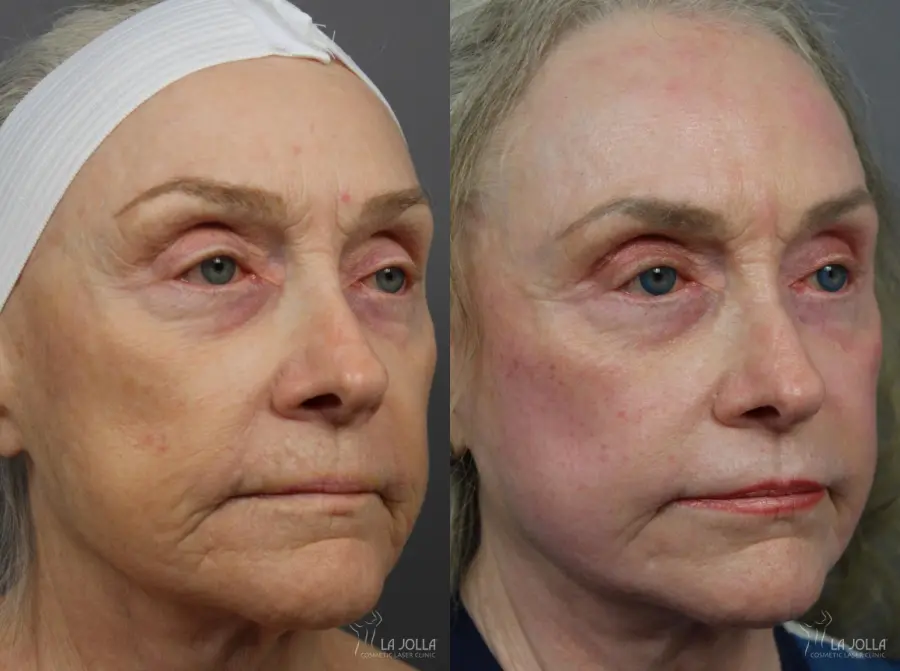 CO2 Laser: Patient 6 - Before and After  