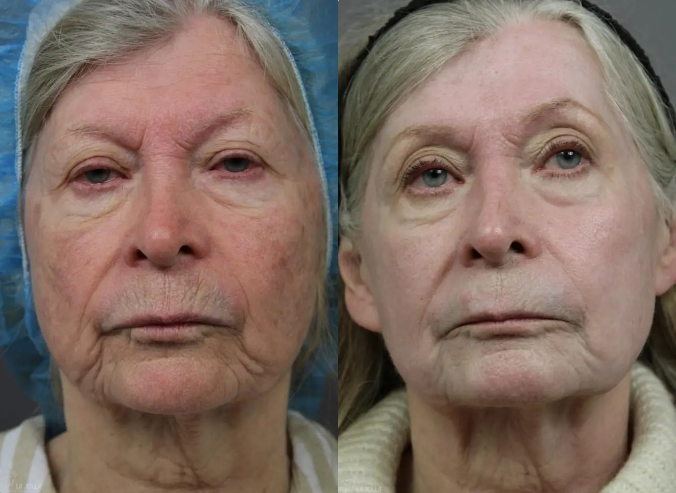 CO2 Laser: Patient 2 - Before and After  