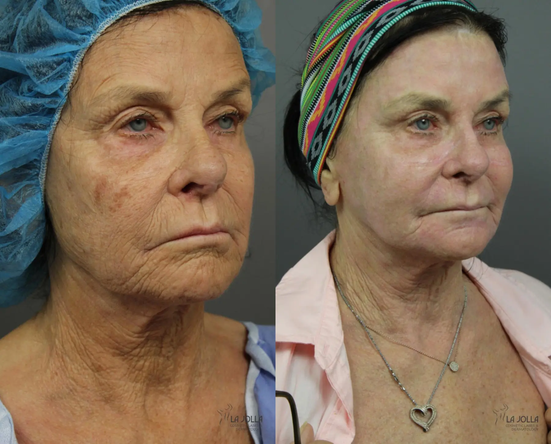 CO2 Laser: Patient 1 - Before and After 2