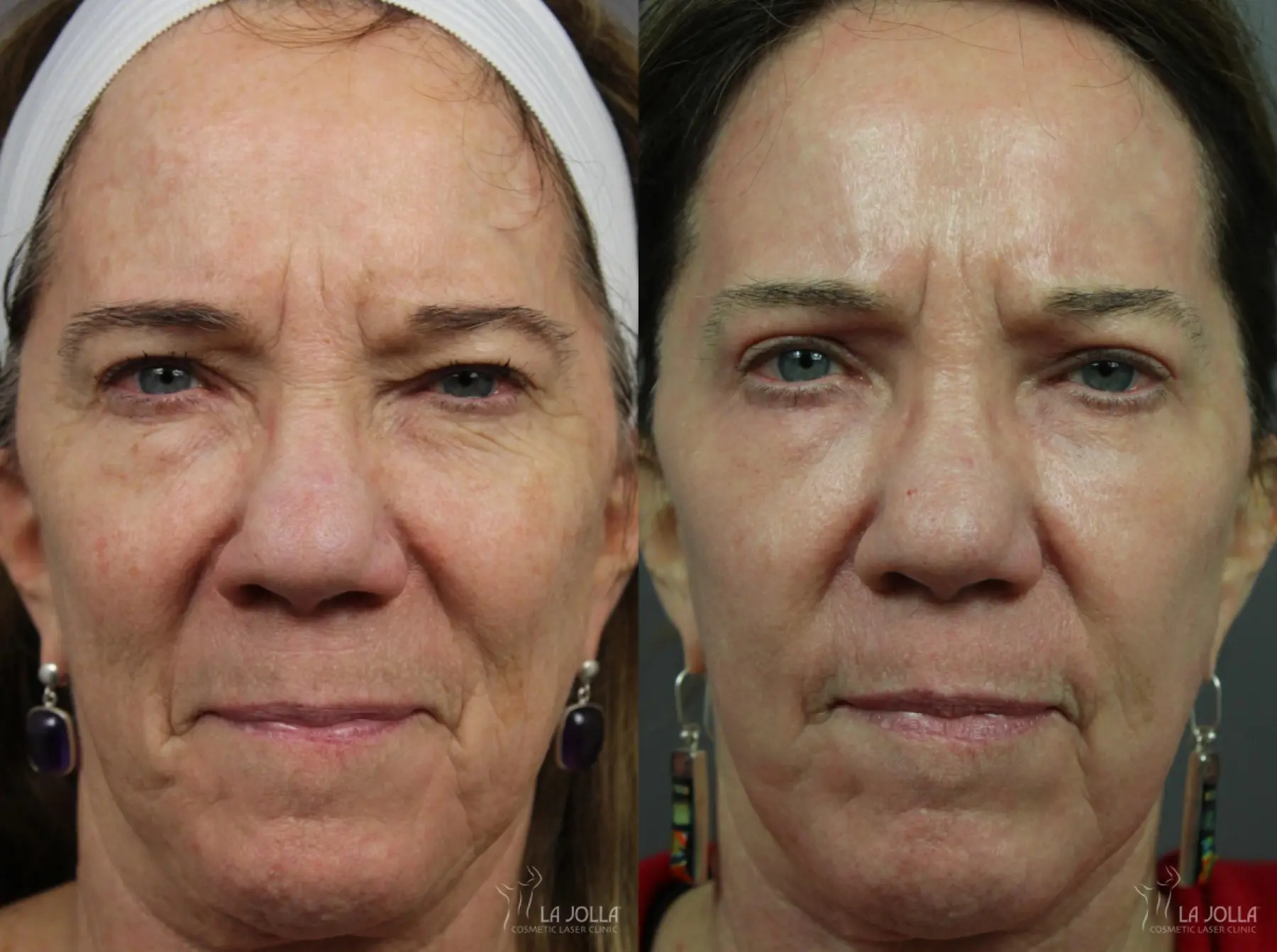 CO2 Laser: Patient 6 - Before and After 2
