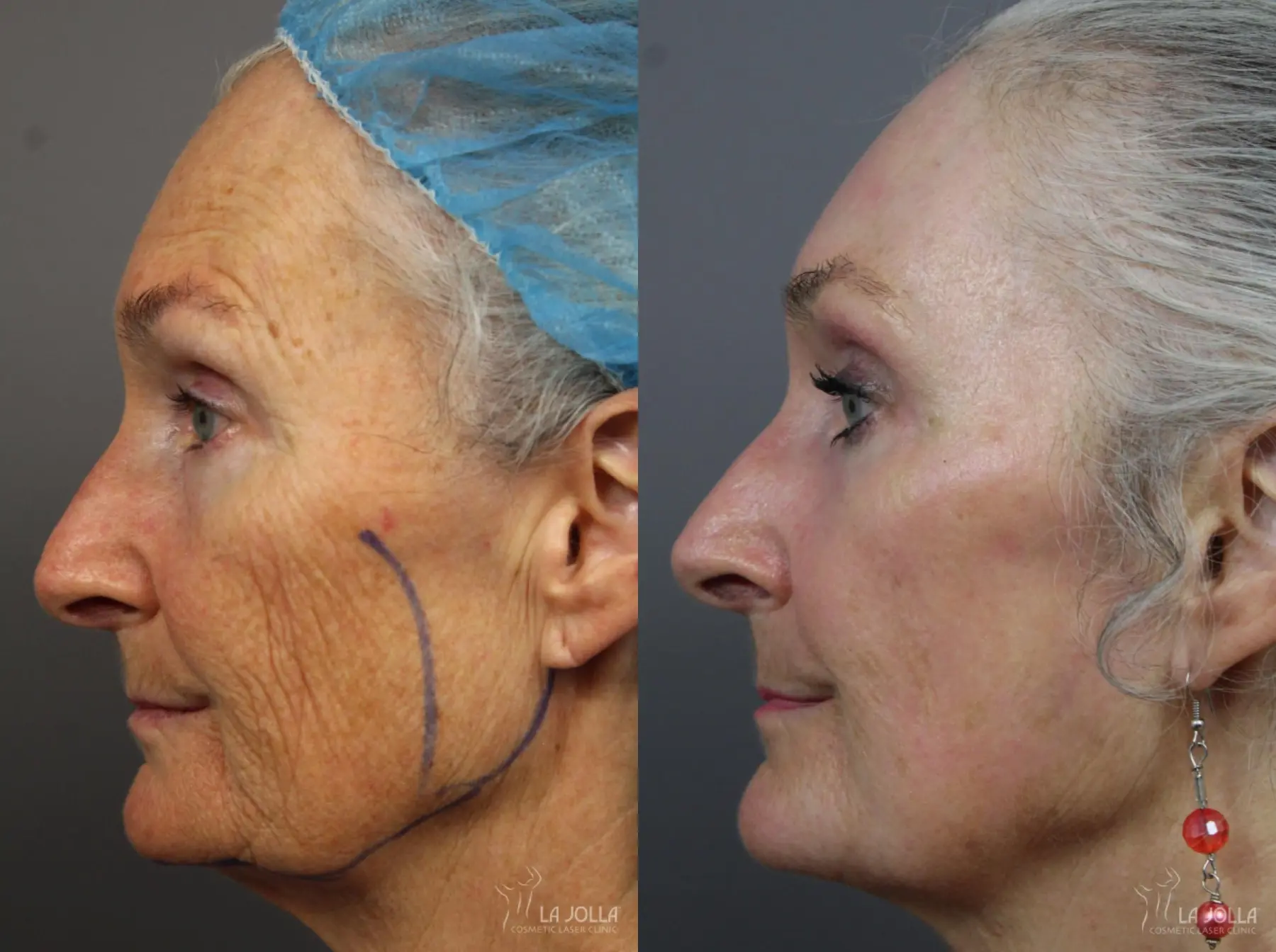 CO2 Laser: Patient 3 - Before and After 3
