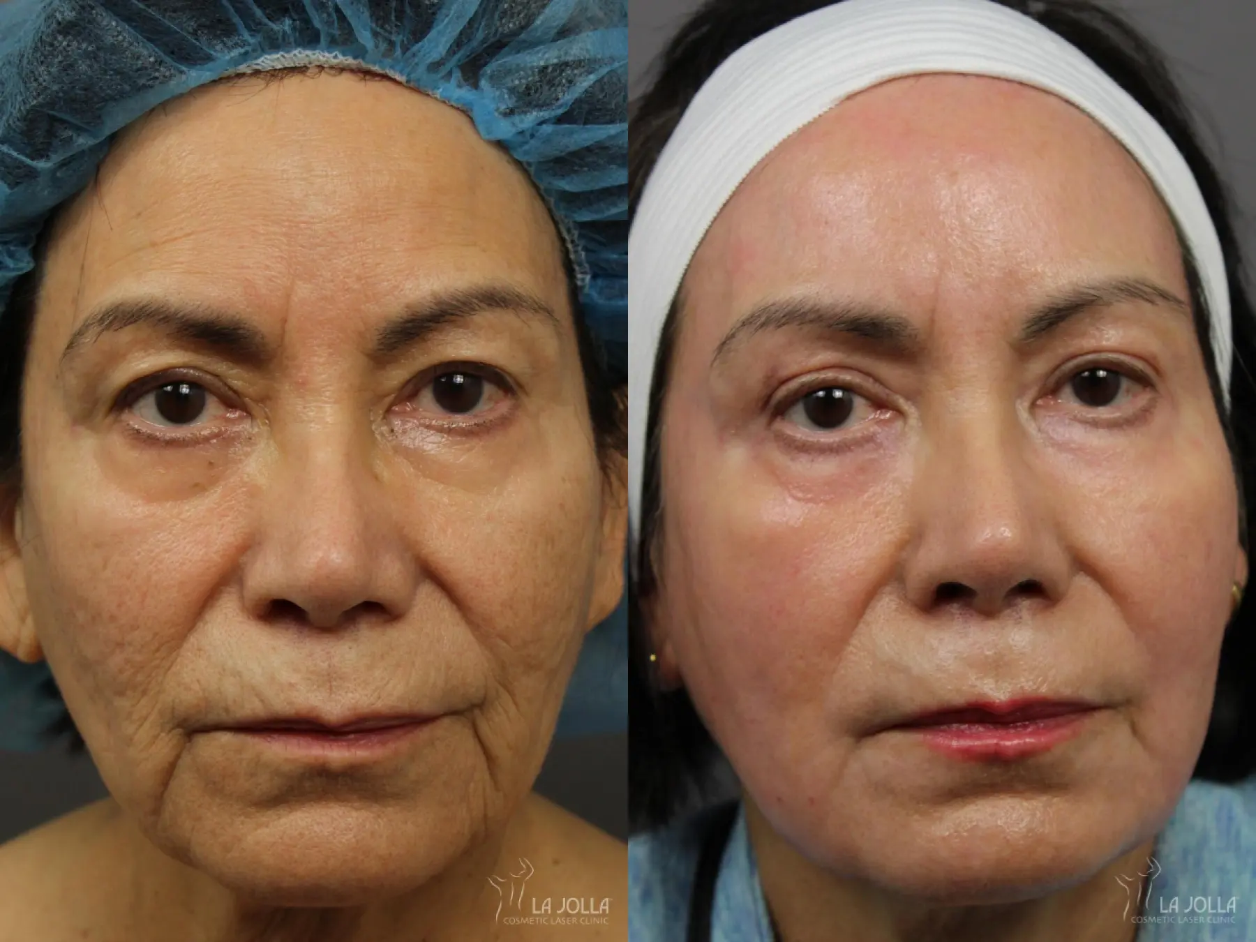 CO2 Laser: Patient 1 - Before and After 3
