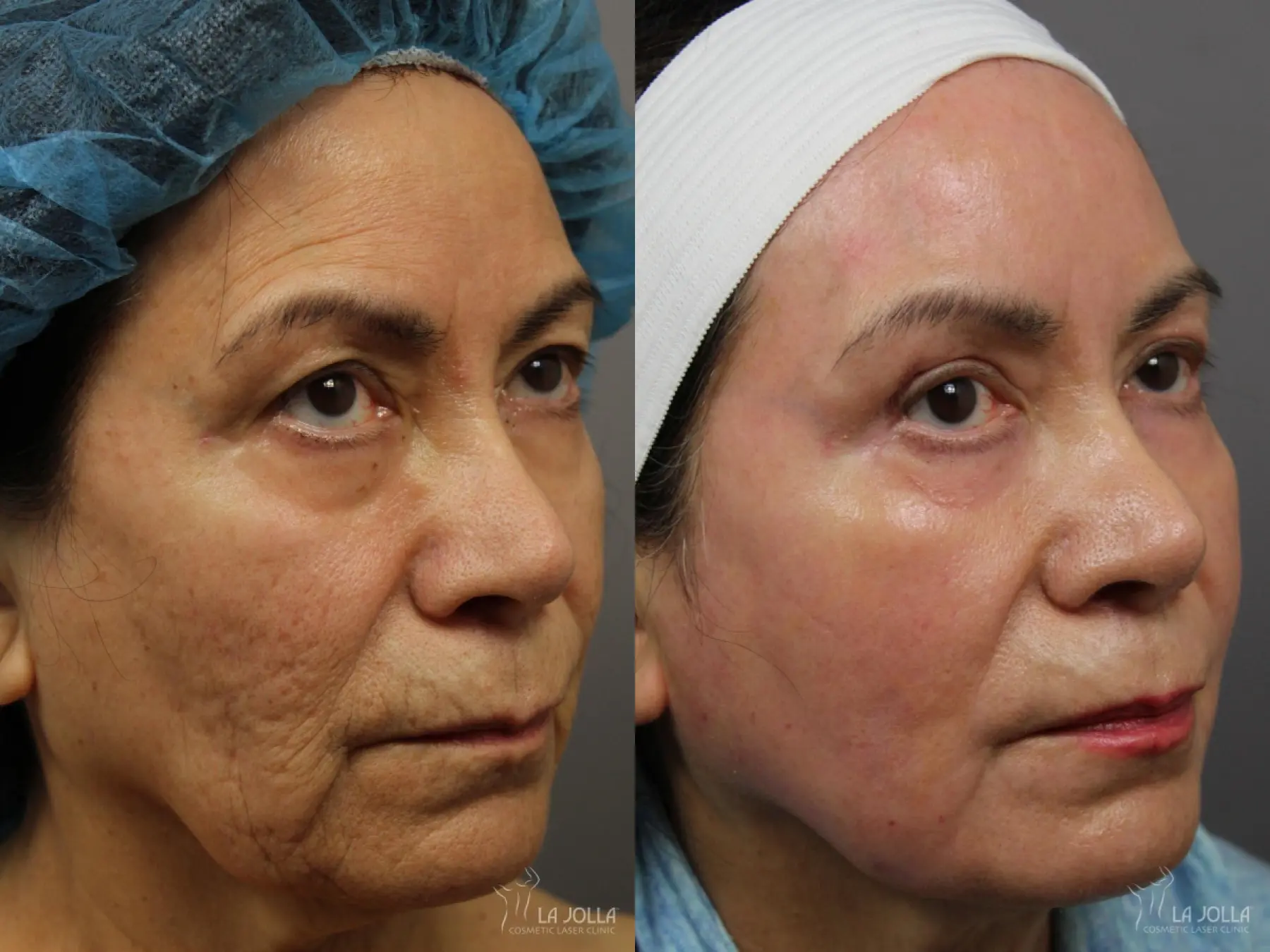 CO2 Laser: Patient 8 - Before and After  