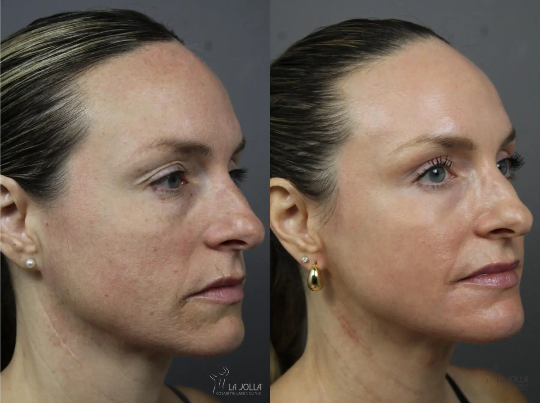 CO2 Laser: Patient 5 - Before and After 2