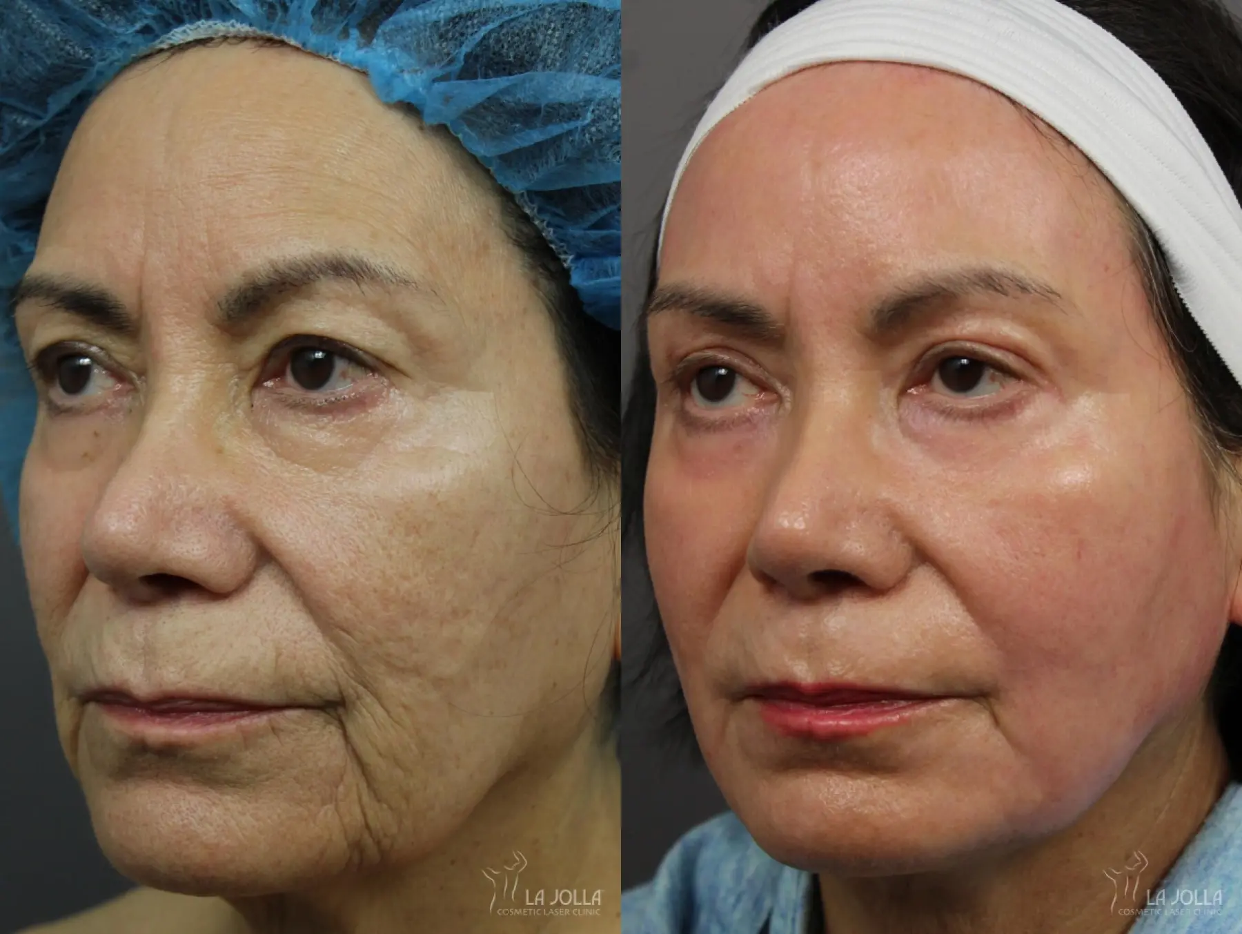 CO2 Laser: Patient 8 - Before and After 2