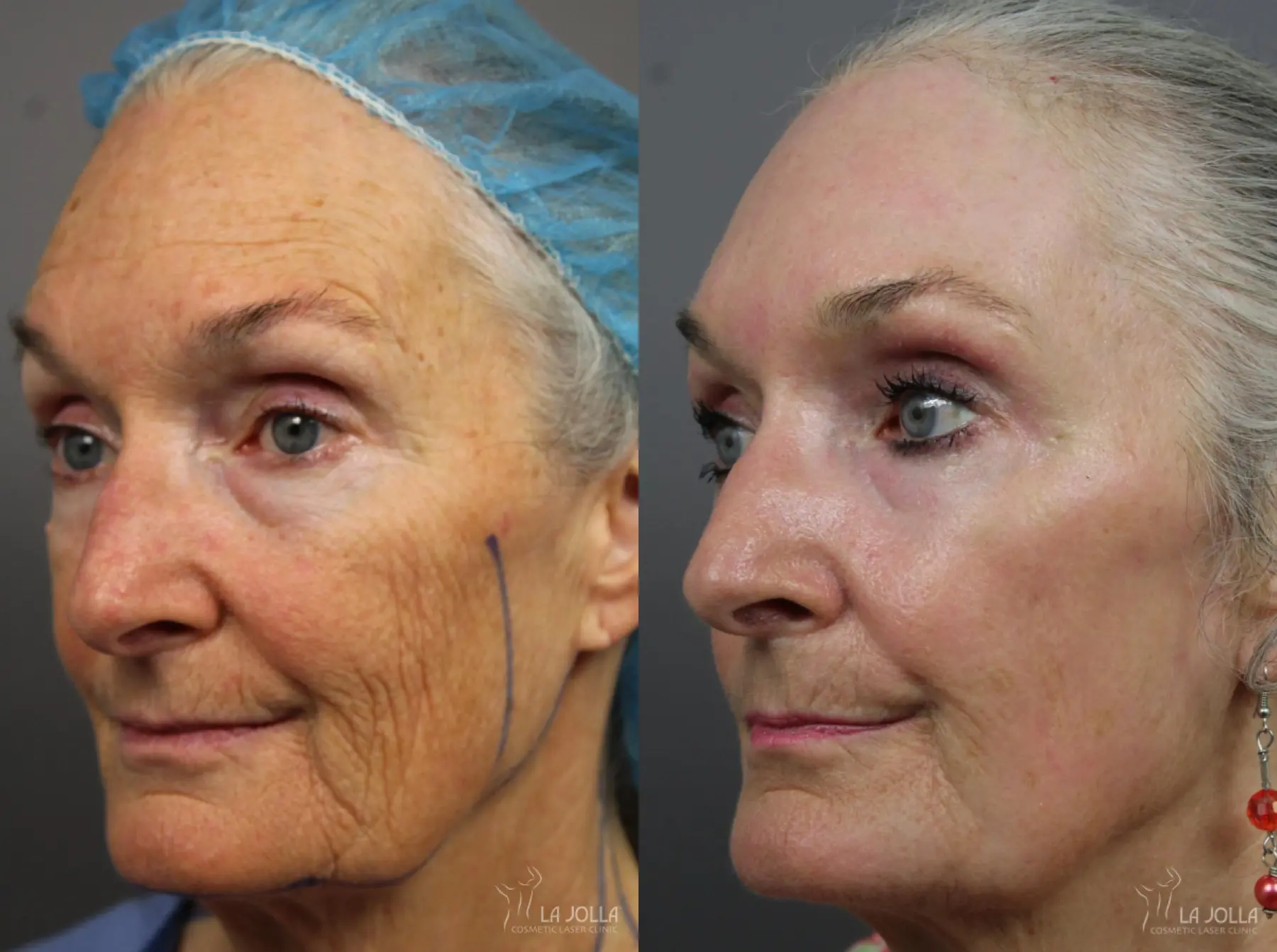 CO2 Laser: Patient 10 - Before and After 2