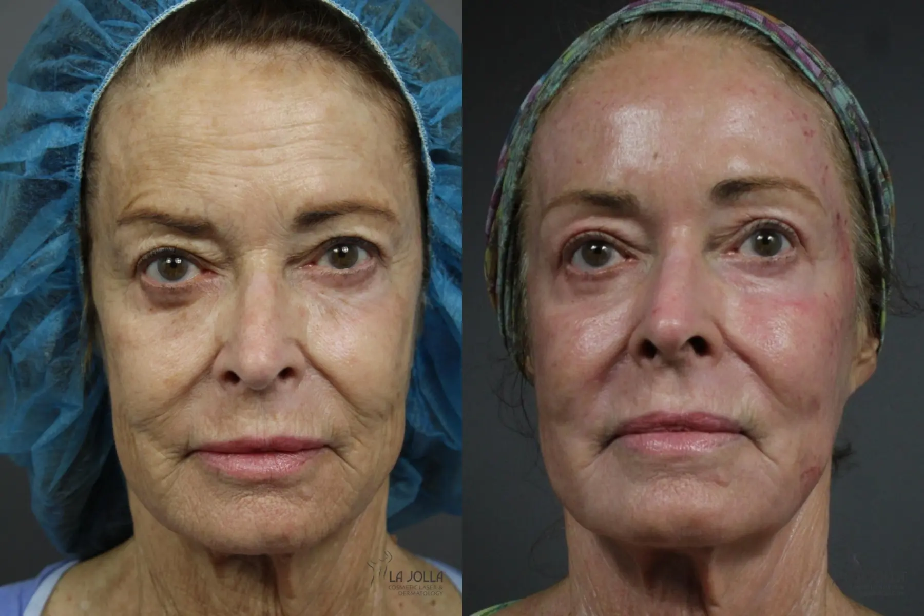CO2 Laser: Patient 1 - Before and After  