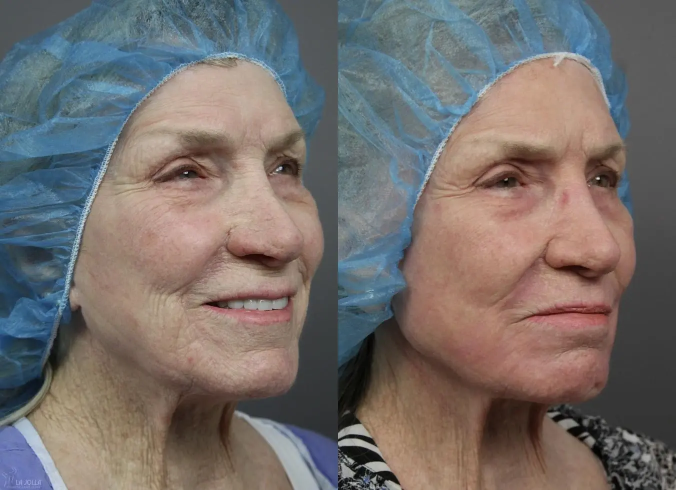 CO2 Laser: Patient 1 - Before and After 3