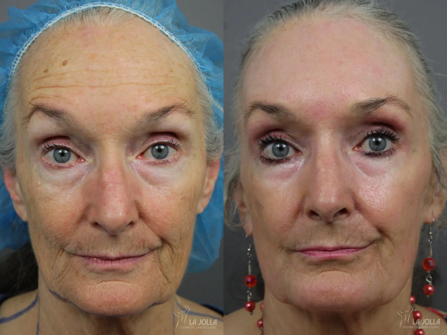 CO2 Laser: Patient 10 - Before and After  