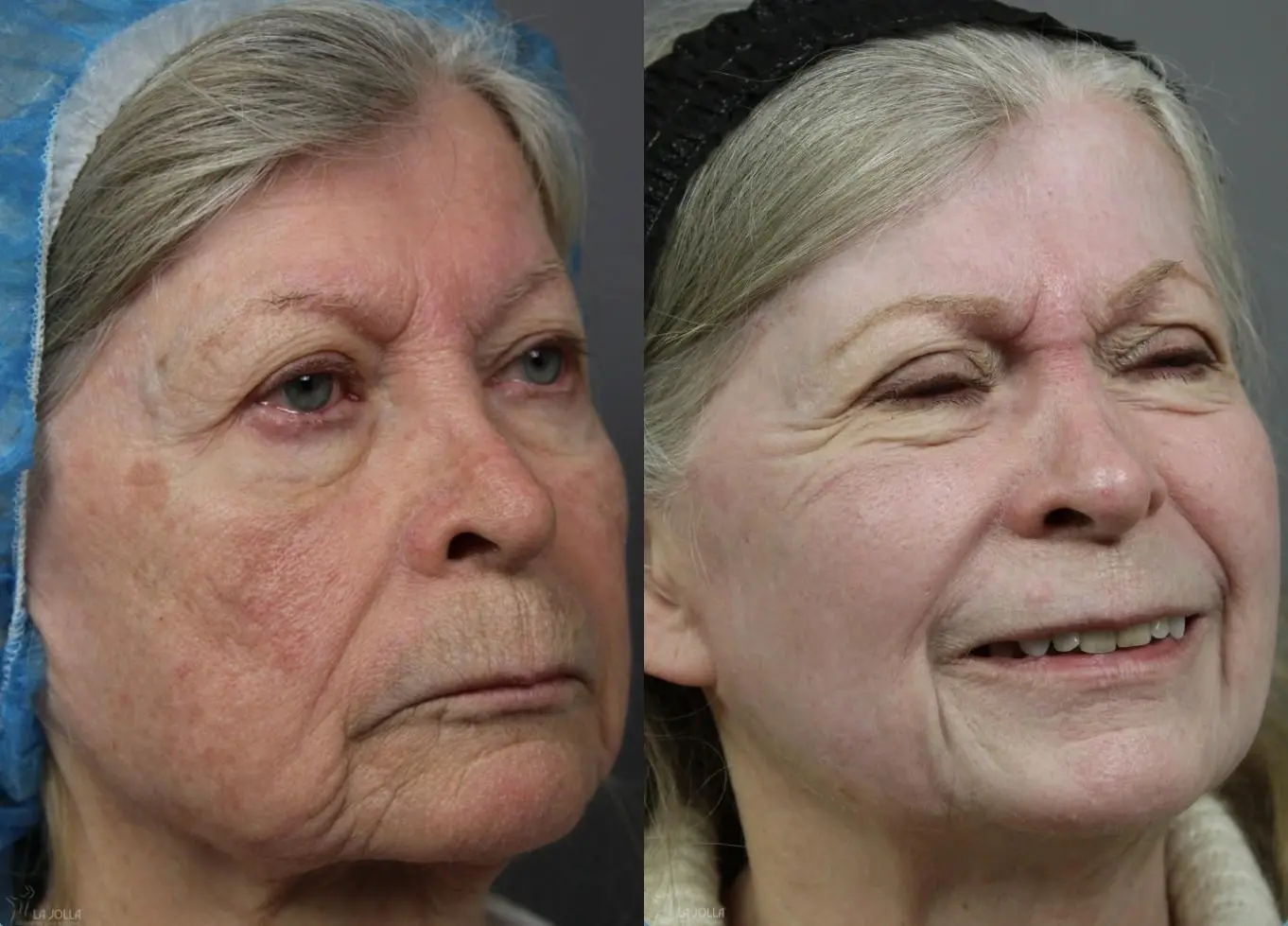 CO2 Laser: Patient 2 - Before and After 3