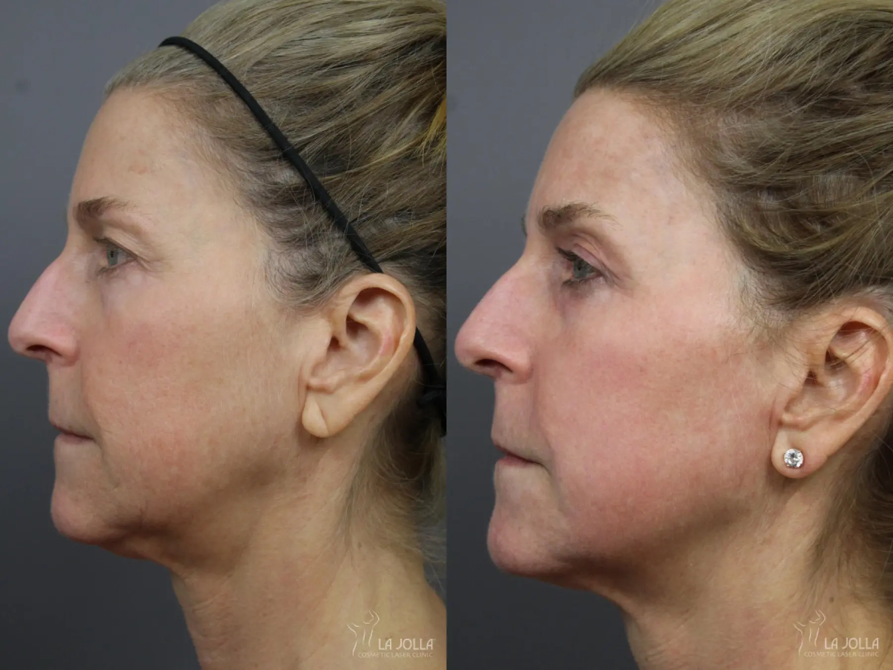 CO2 Laser: Patient 16 - Before and After 2