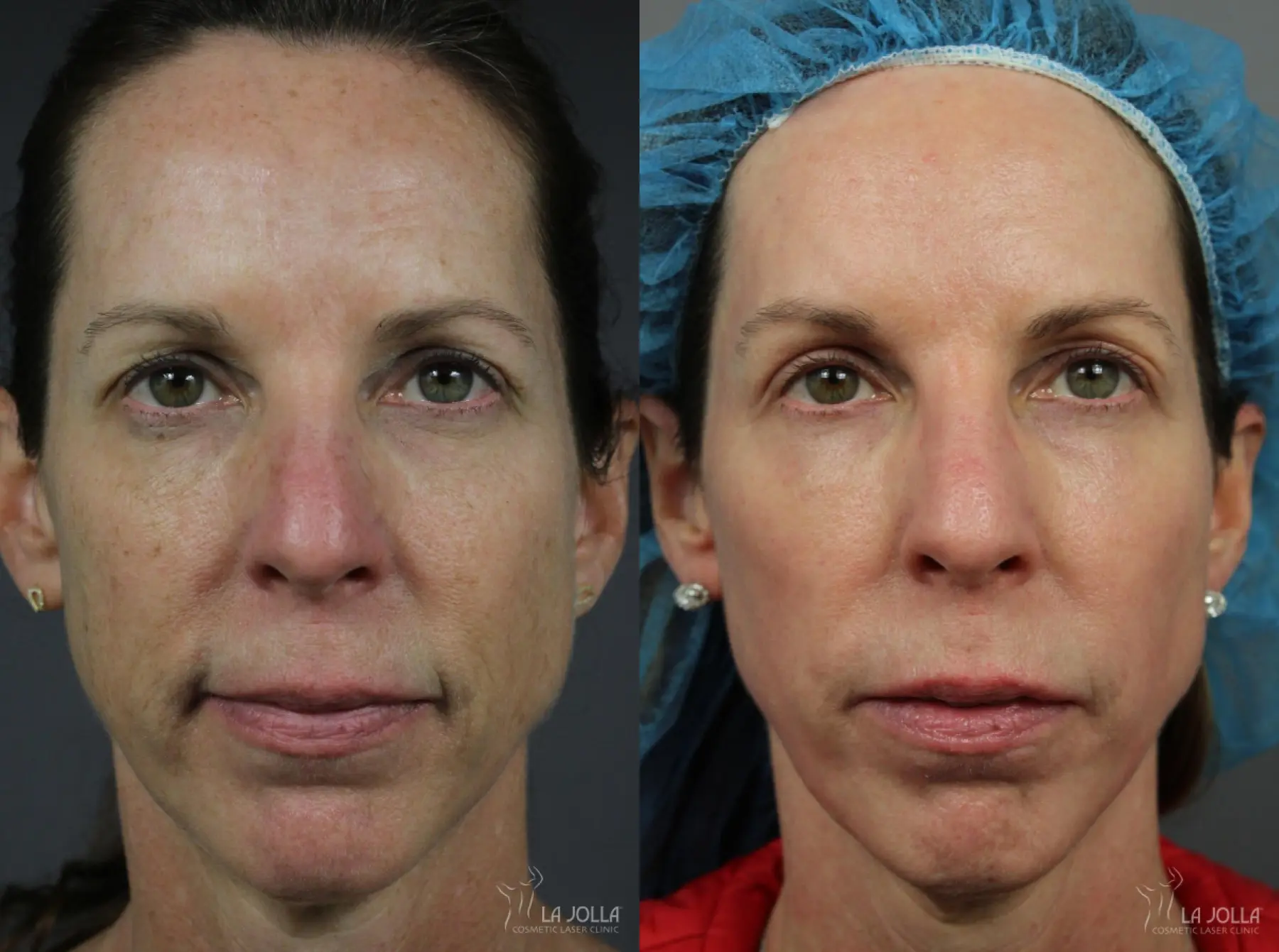CO2 Laser: Patient 7 - Before and After 1