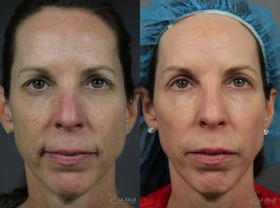 CO2 Laser: Patient 7 - Before and After  