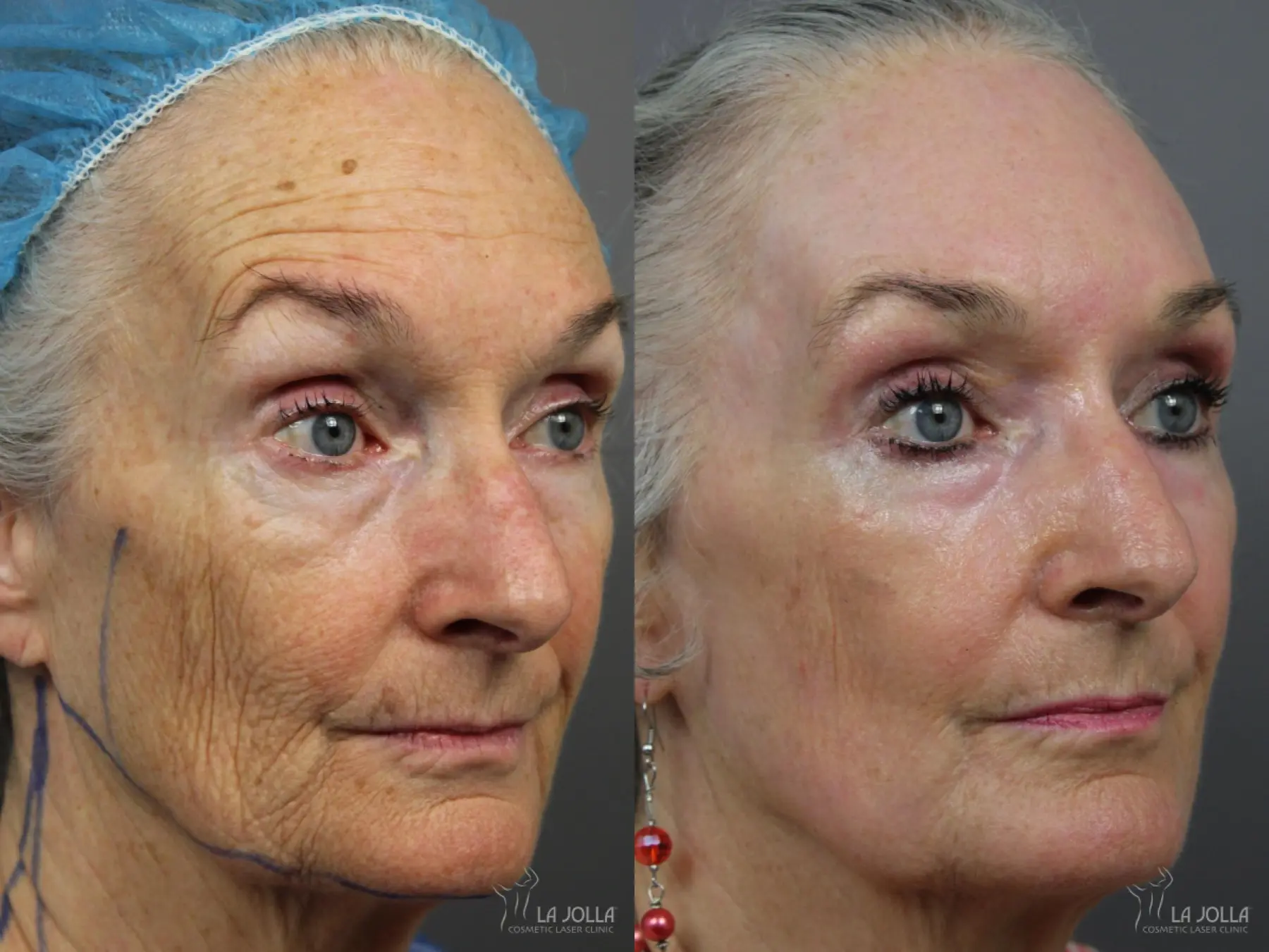 CO2 Laser: Patient 3 - Before and After 4