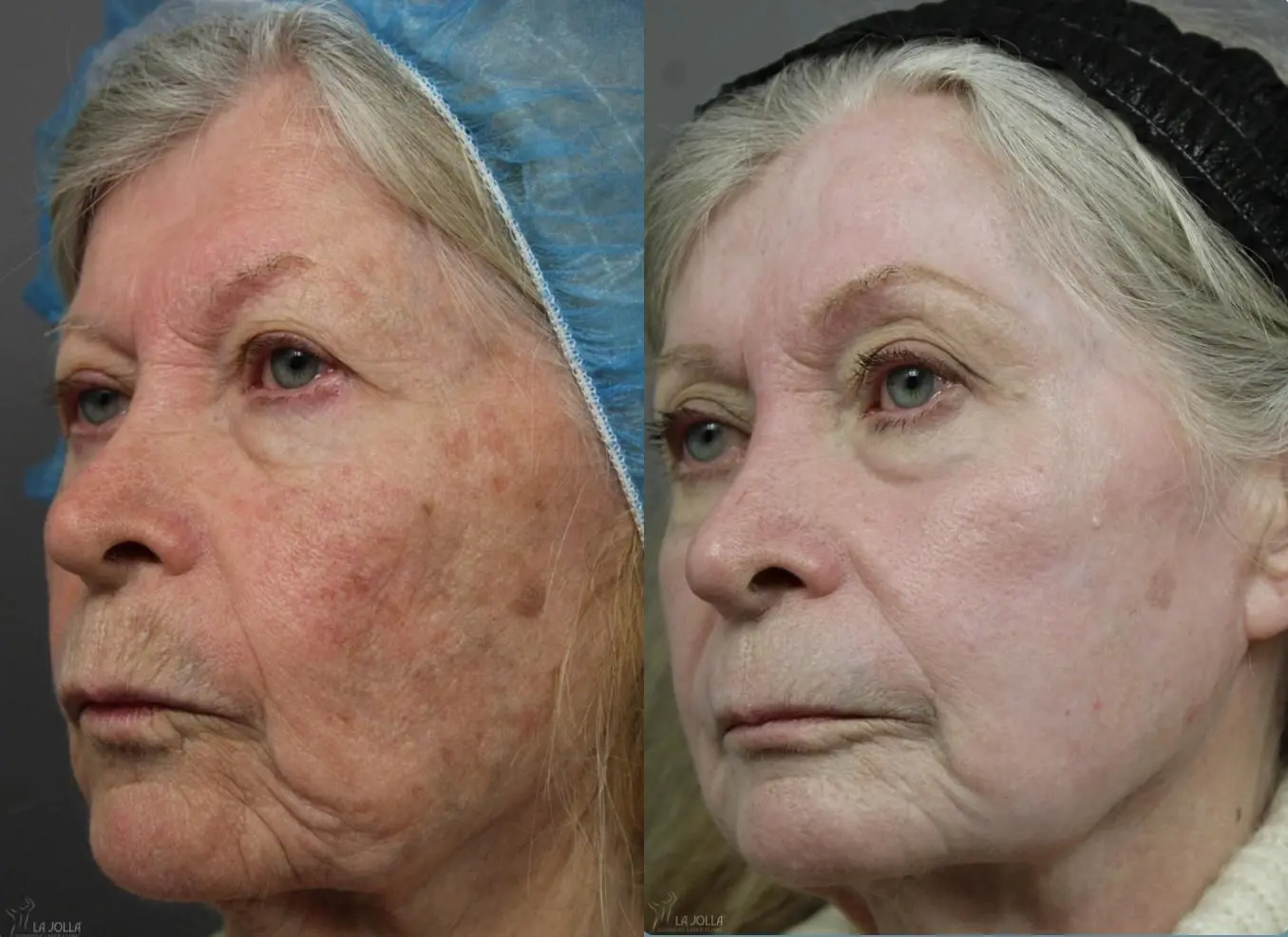 CO2 Laser: Patient 2 - Before and After 2