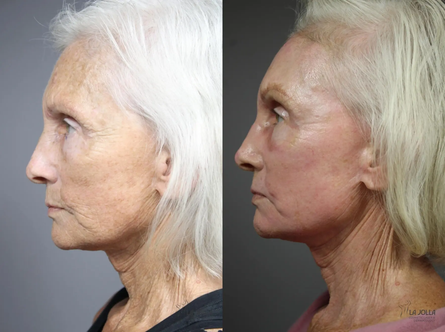 CO2 Laser: Patient 2 - Before and After 2