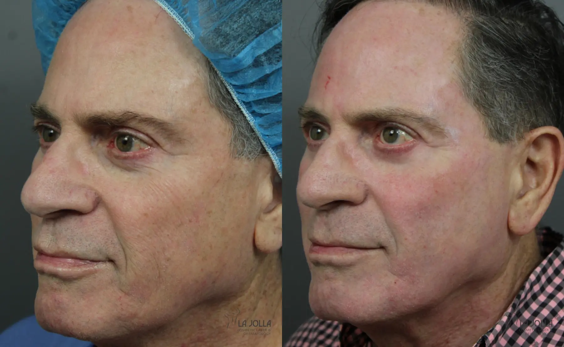 CO2 Laser: Patient 2 - Before and After 3