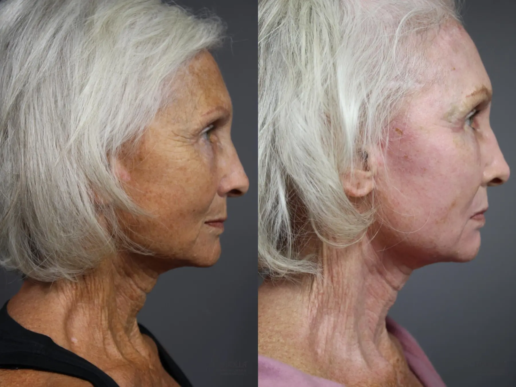 CO2 Laser: Patient 2 - Before and After 3